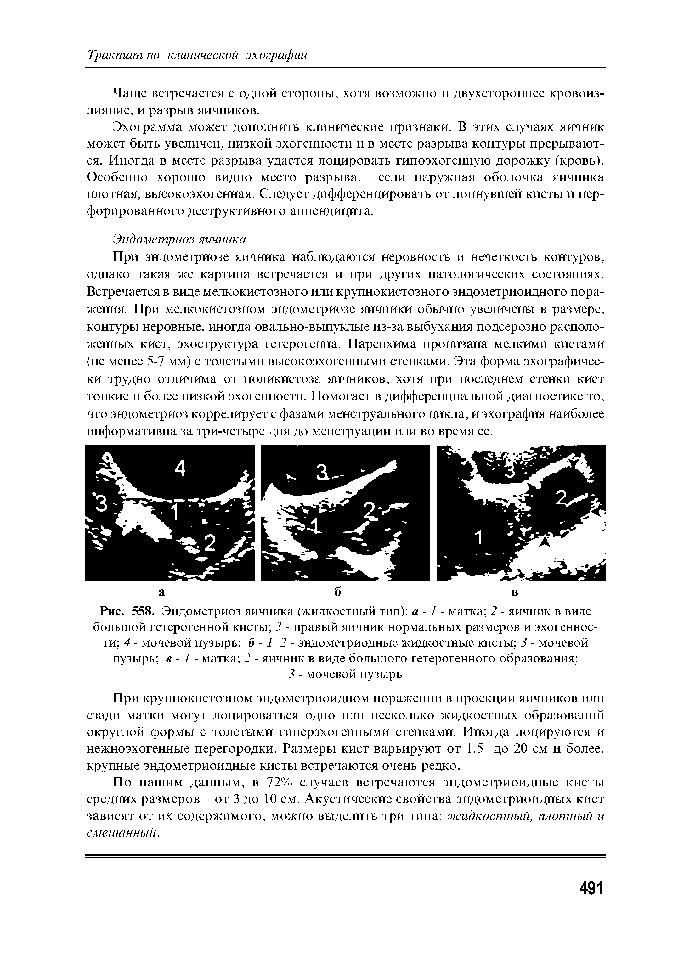 Рис. 558. Эндометриоз яичника (жидкостный тип) а -1 - матка 2 - яичник в виде большой гетерогенной кисты 3 - правый яичник нормальных размеров и эхогенности 4 - мочевой пузырь 6-1,2- эндометриодные жидкостные кисты 3 - мочевой пузырь в -1 - матка 2 - яичник в виде большого гетерогенного образования ...