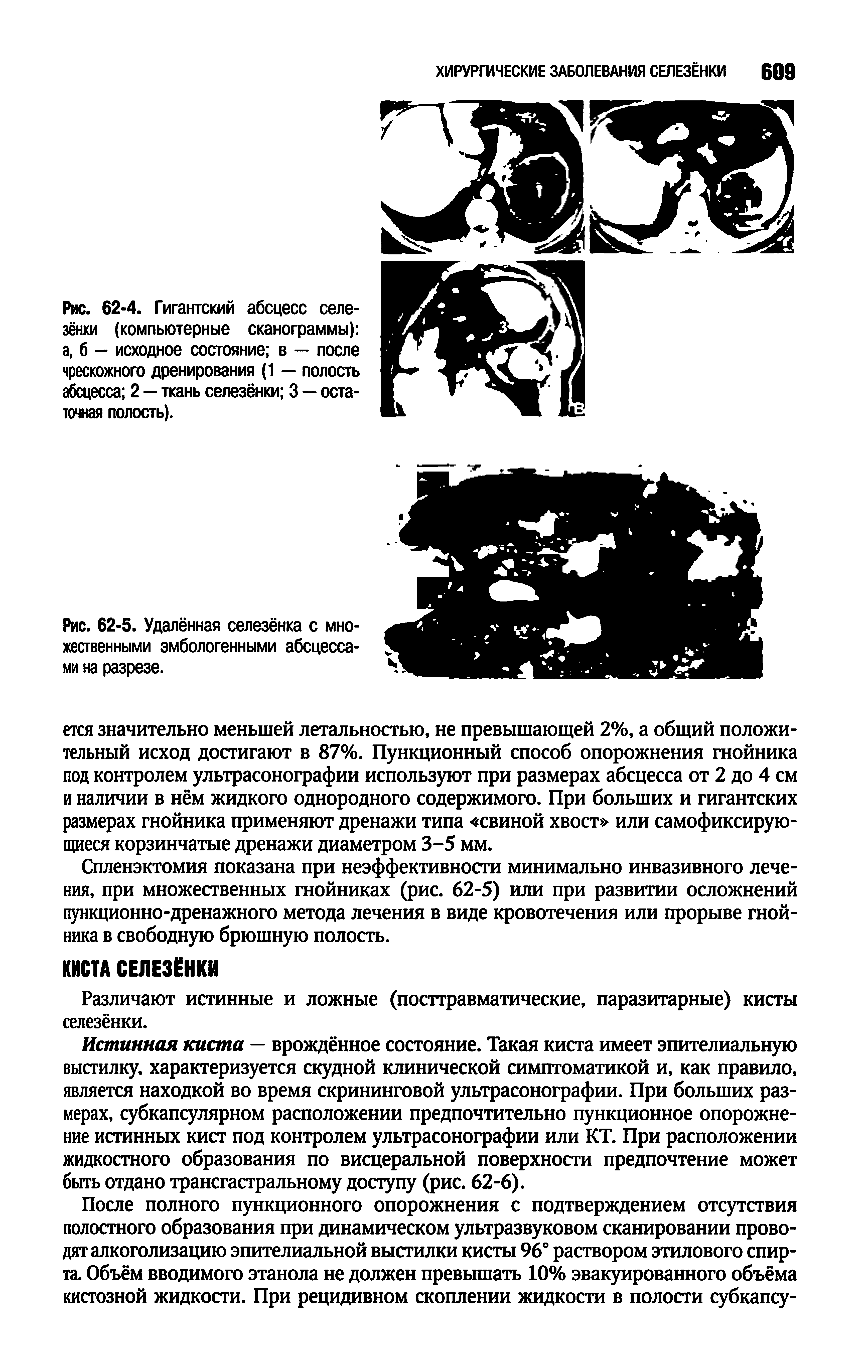 Рис. 62-5. Удалённая селезёнка с множественными эмбологенными абсцессами на разрезе.