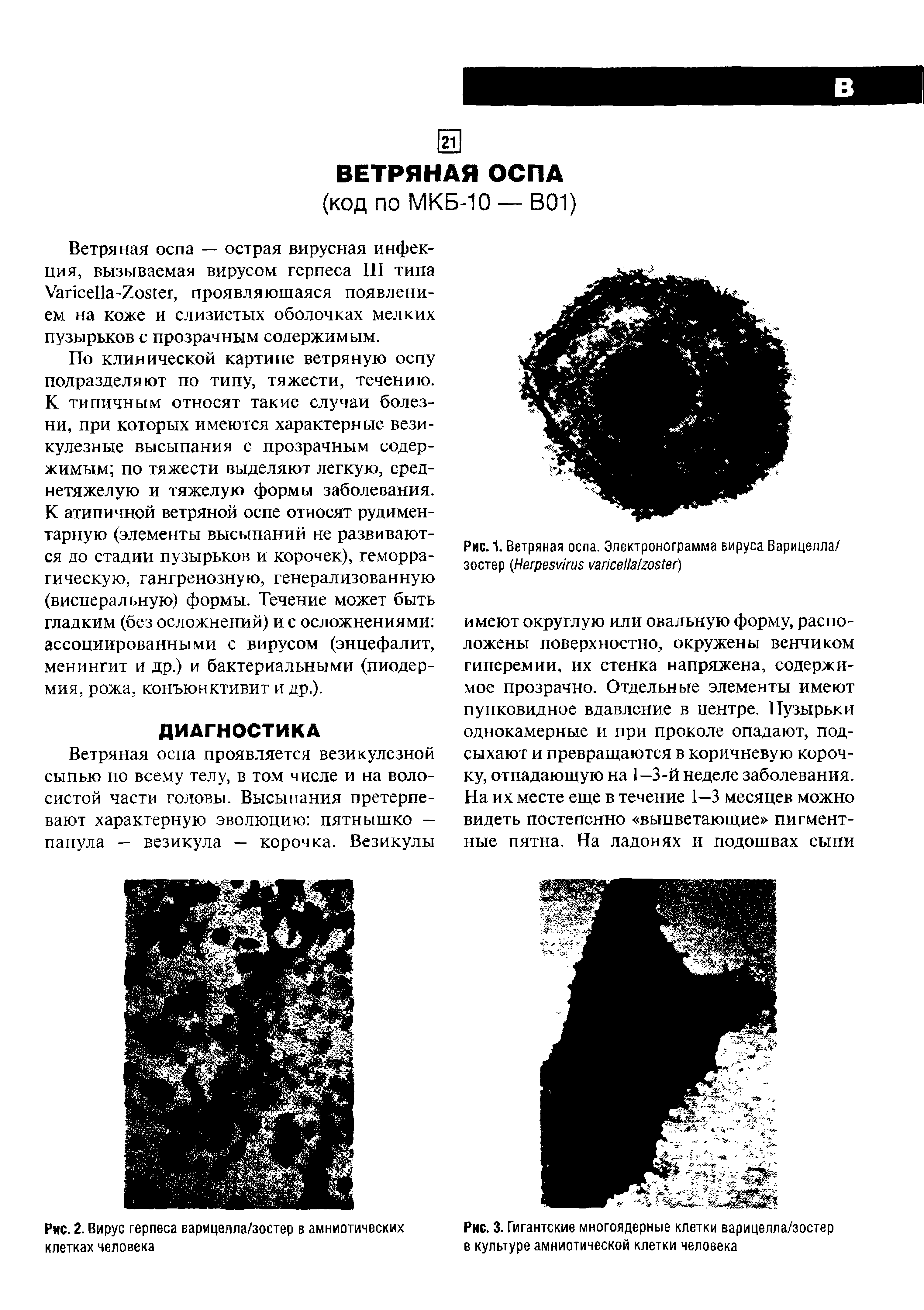 Рис. 1. Ветряная оспа. Электронограмма вируса Варицелла/ зостер H / )...