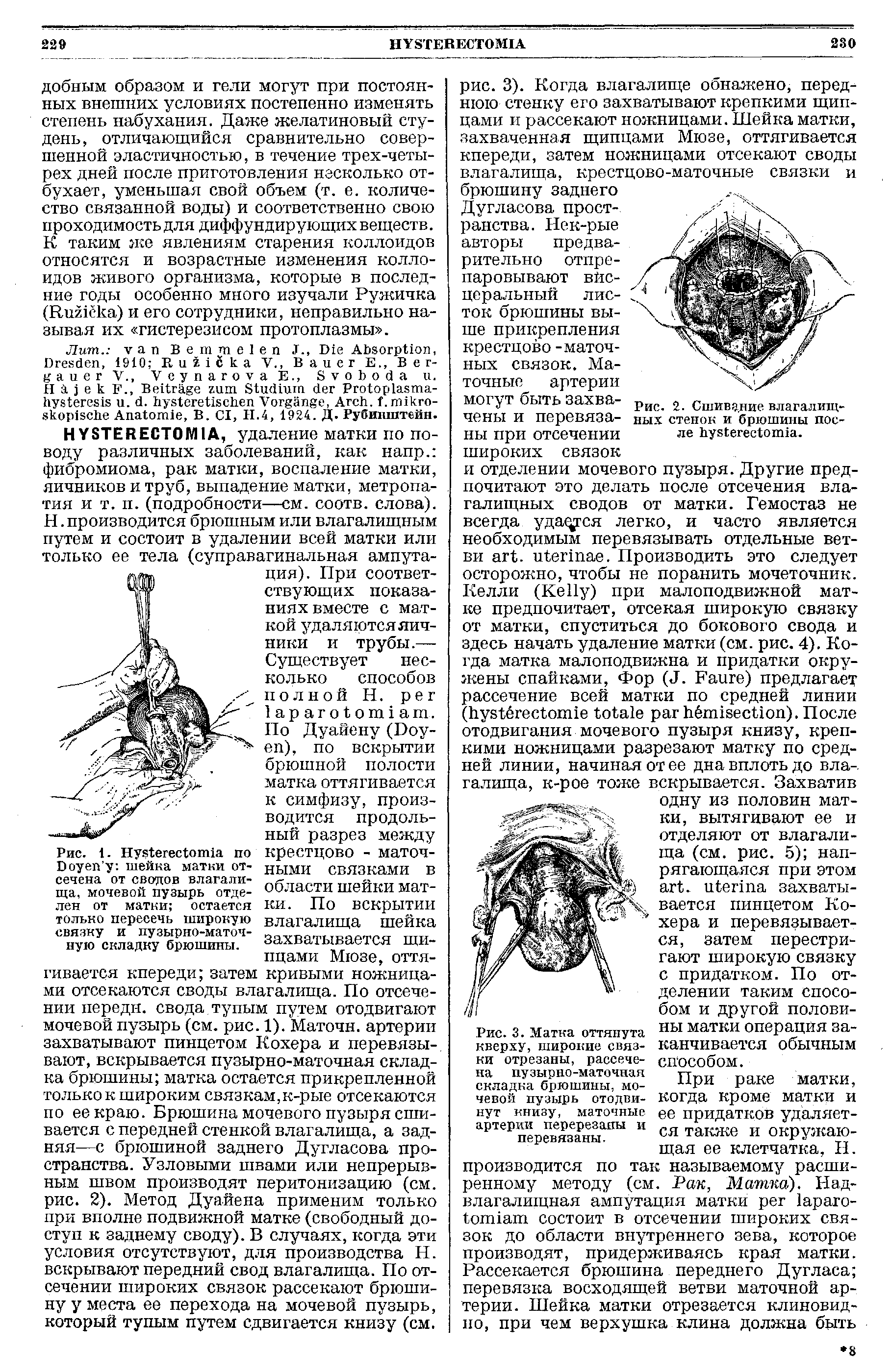 Рис. 1. Ну. егесЩппа по Соуйп. у шейка матки отсечена от сводов влагалища, мочевой пузырь отделен от матки остается только пересечь широкую связку и пузырно-маточную складку брюшины.