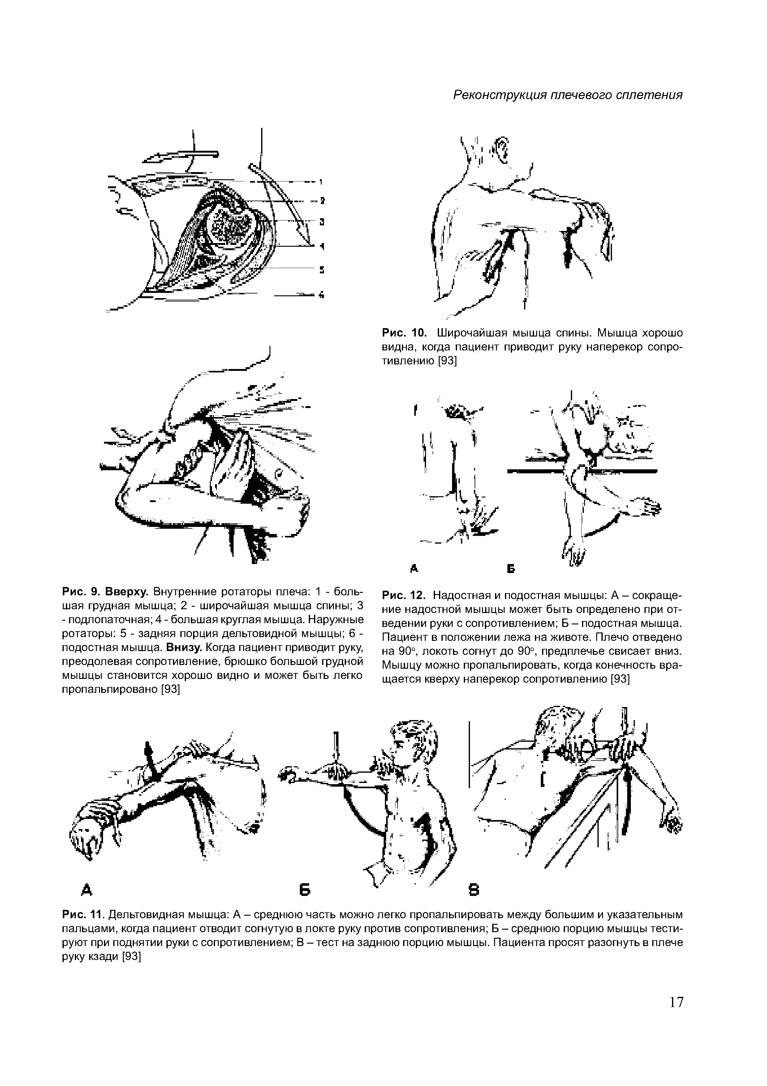 Рис. 12. Надостная и подостная мышцы А - сокращение надостной мышцы может быть определено при отведении руки с сопротивлением Б - подостная мышца. Пациент в положении лежа на животе. Плечо отведено на 90°, локоть согнут до 90°, предплечье свисает вниз. Мышцу можно пропальпировать, когда конечность вращается кверху наперекор сопротивлению [93]...