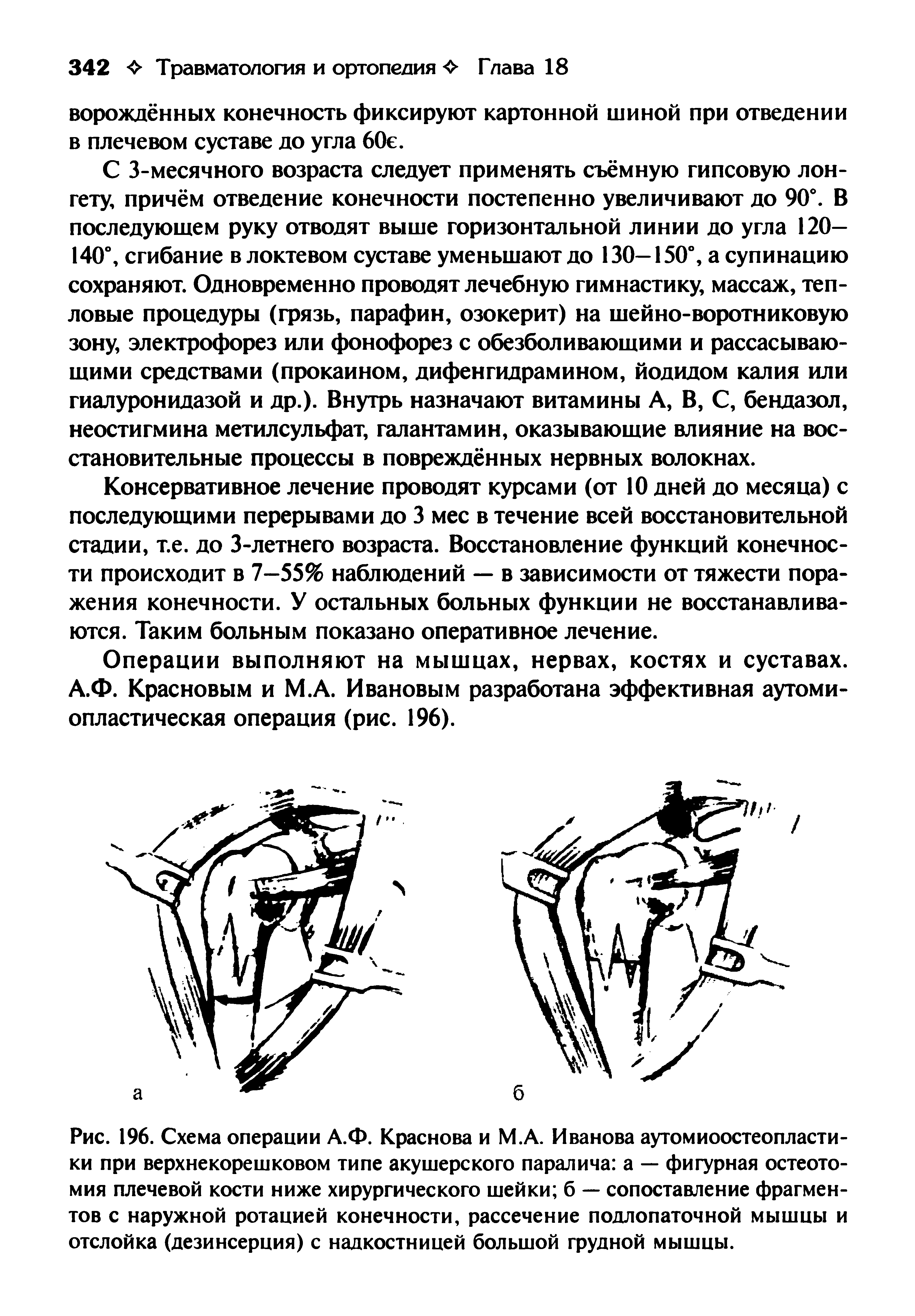 Рис. 196. Схема операции А.Ф. Краснова и М.А. Иванова аутомиоостеопластики при верхнекорешковом типе акушерского паралича а — фигурная остеотомия плечевой кости ниже хирургического шейки б — сопоставление фрагментов с наружной ротацией конечности, рассечение подлопаточной мышцы и отслойка (дезинсерция) с надкостницей большой грудной мышцы.