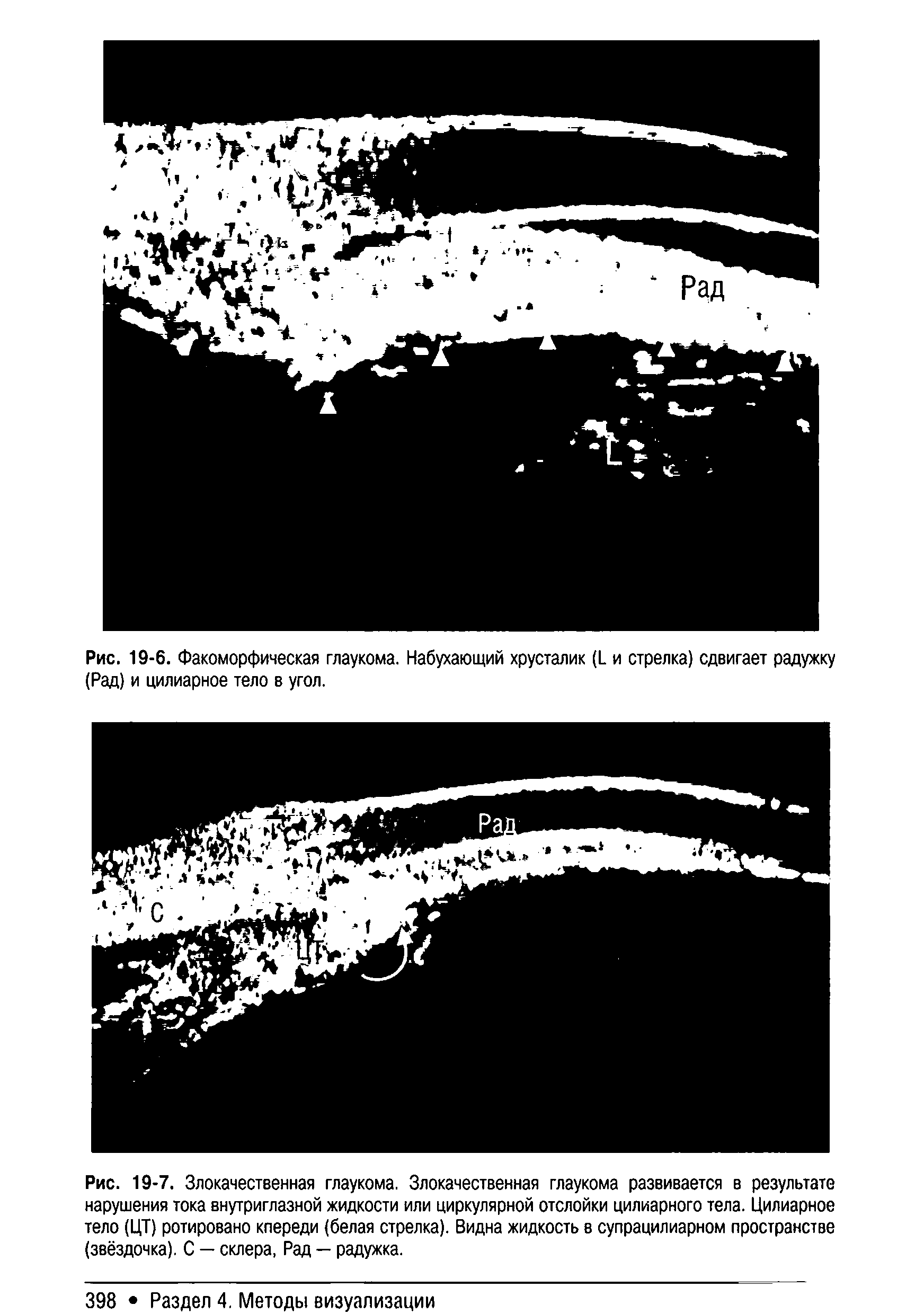 Рис. 19-7. Злокачественная глаукома. Злокачественная глаукома развивается в результате нарушения тока внутриглазной жидкости или циркулярной отслойки цилиарного тела. Цилиарное тело (ЦТ) ротировано кпереди (белая стрелка). Видна жидкость в супрацилиарном пространстве (звёздочка). С — склера, Рад — радужка.