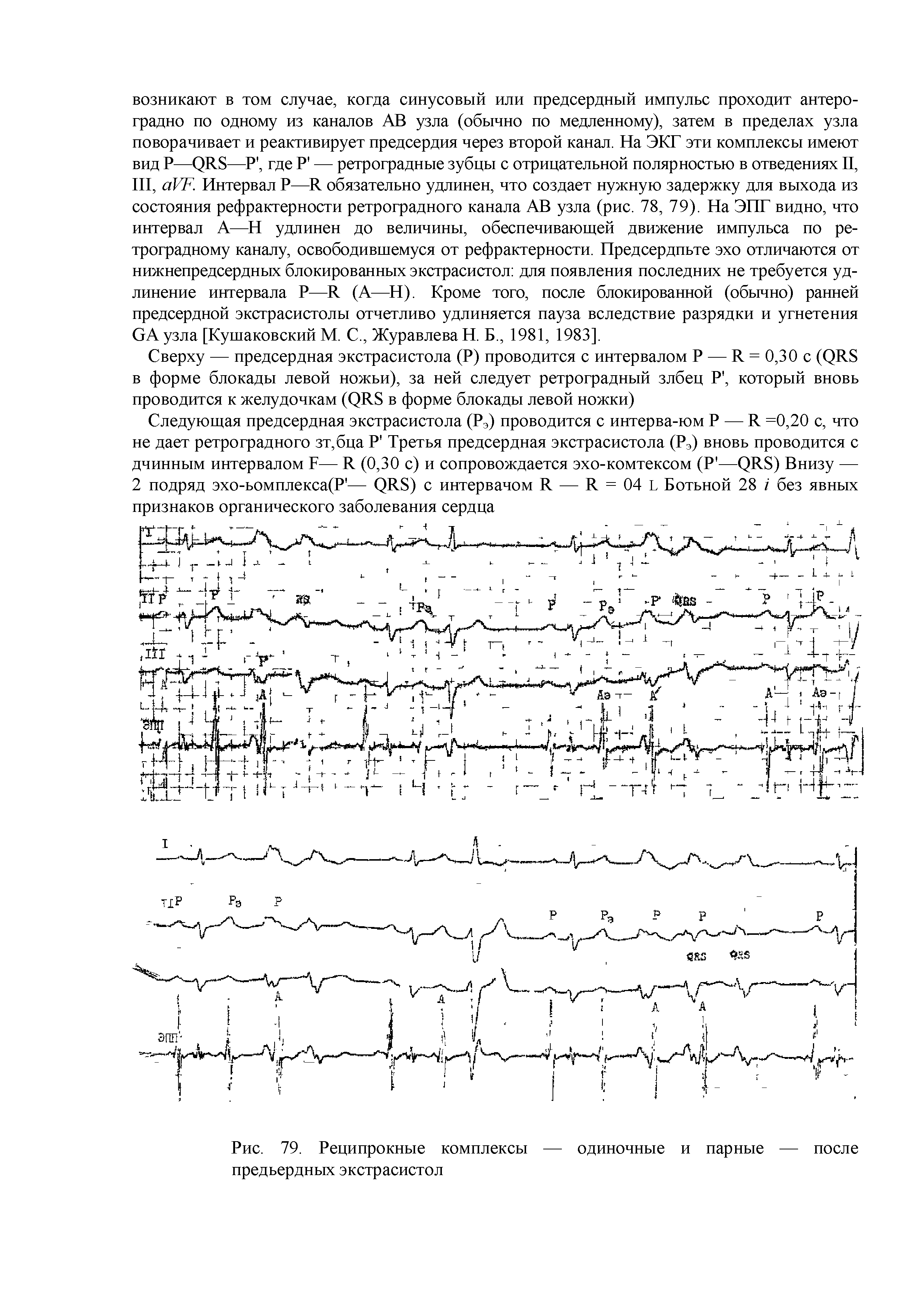 Рис. 79. Реципрокные комплексы — одиночные и парные — после предьердных экстрасистол...