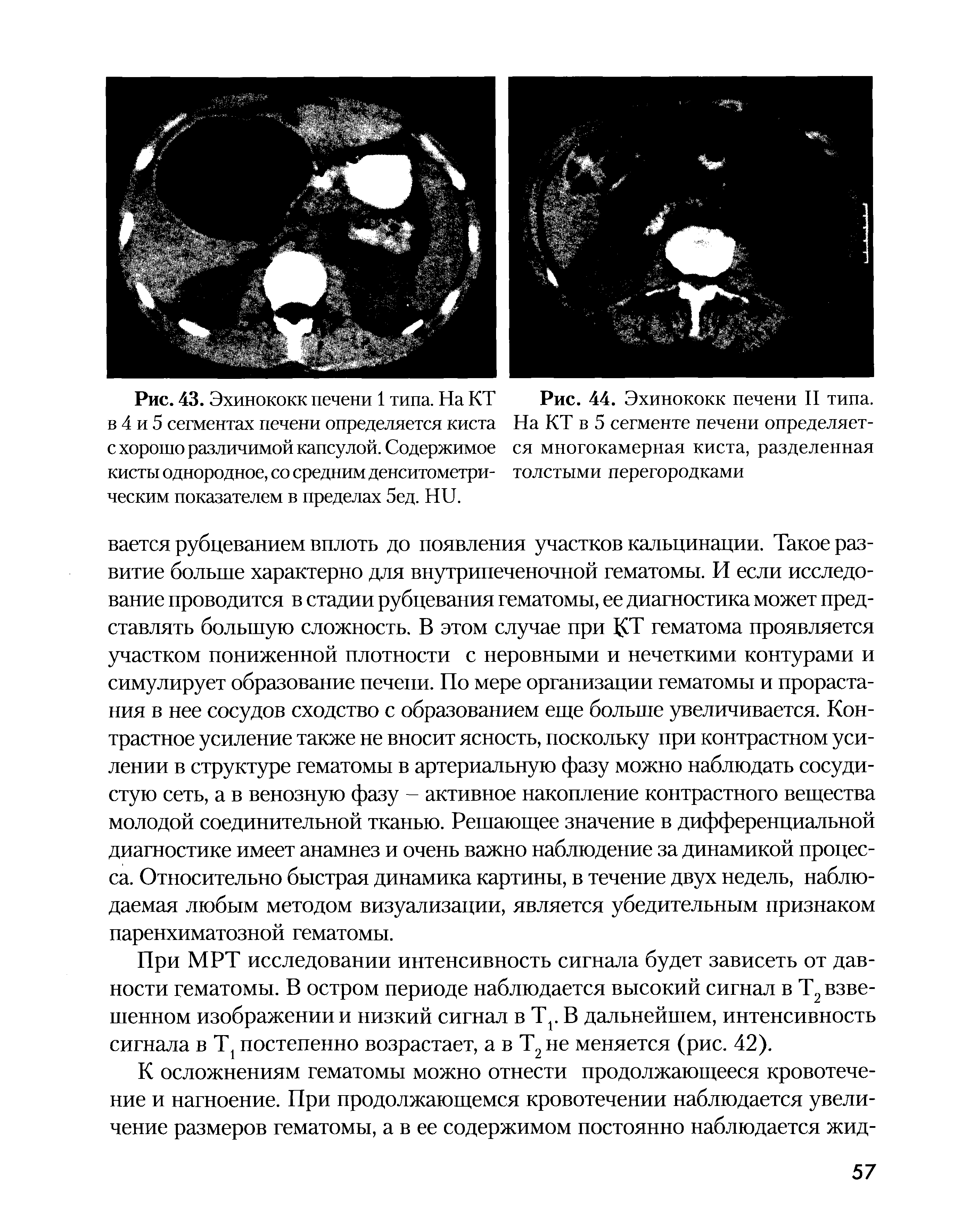 Рис. 44. Эхинококк печени II типа. На КТ в 5 сегменте печени определяется многокамерная киста, разделенная...