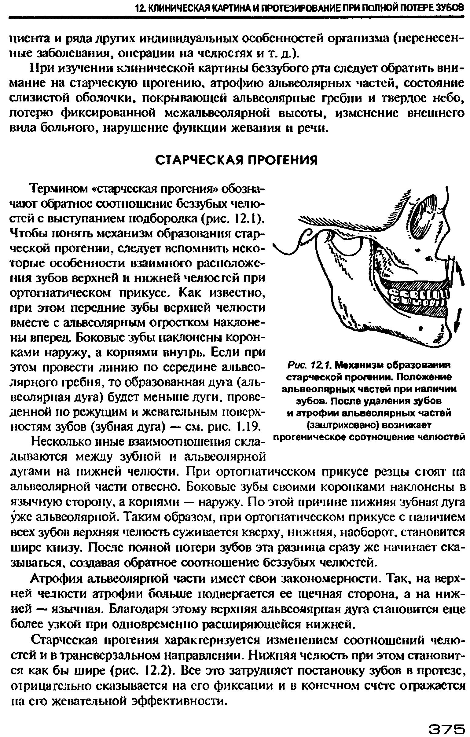 Рис. 12.1. Механизм образования старческой прогении. Положение альвеолярных частей при наличии зубов. После удаления зубов и атрофии альвеолярных частей (заштриховано) возникает прогеническое соотношение челюстей...