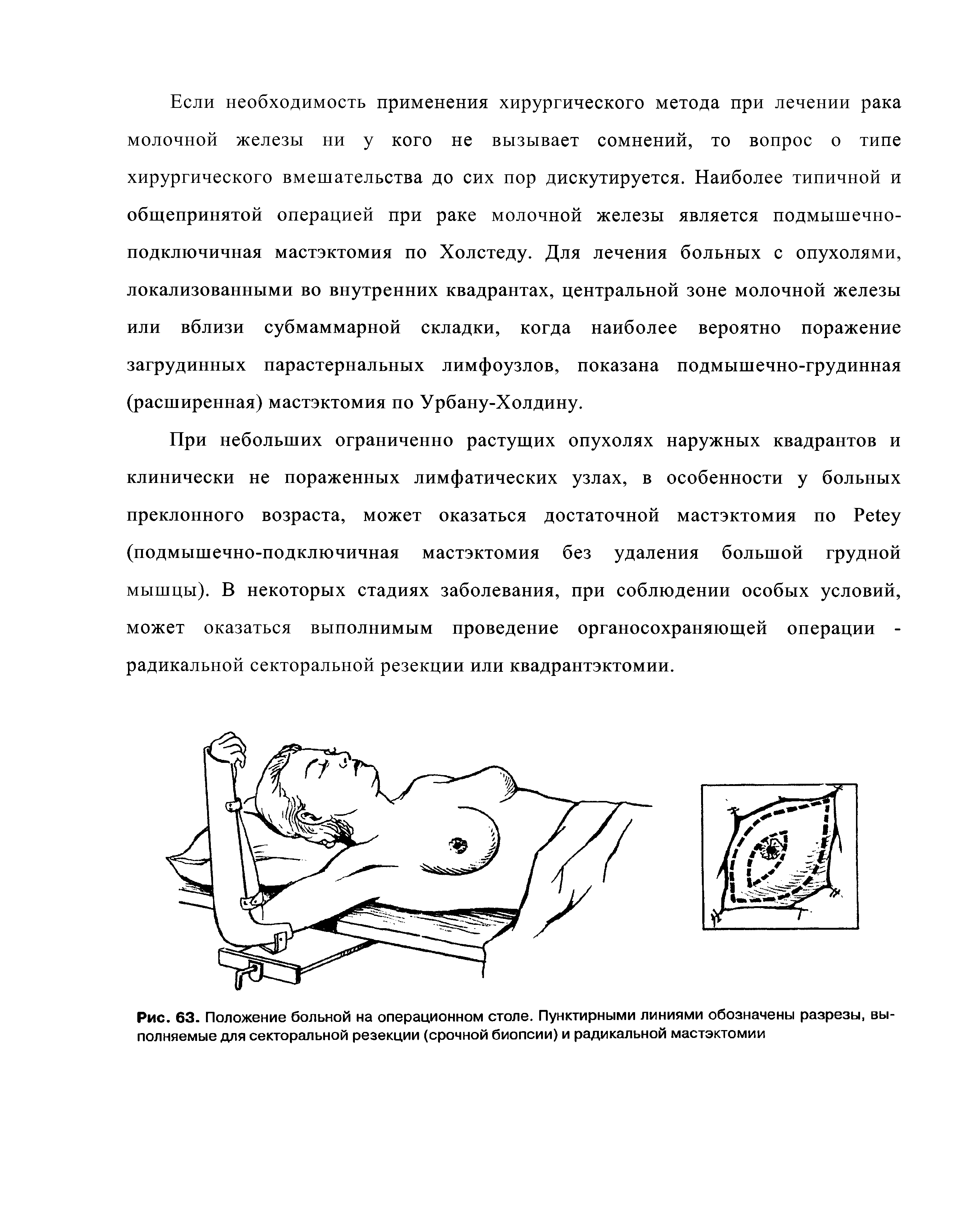 Рис. 63. Положение больной на операционном столе. Пунктирными линиями обозначены разрезы, выполняемые для секторальной резекции (срочной биопсии) и радикальной мастэктомии...