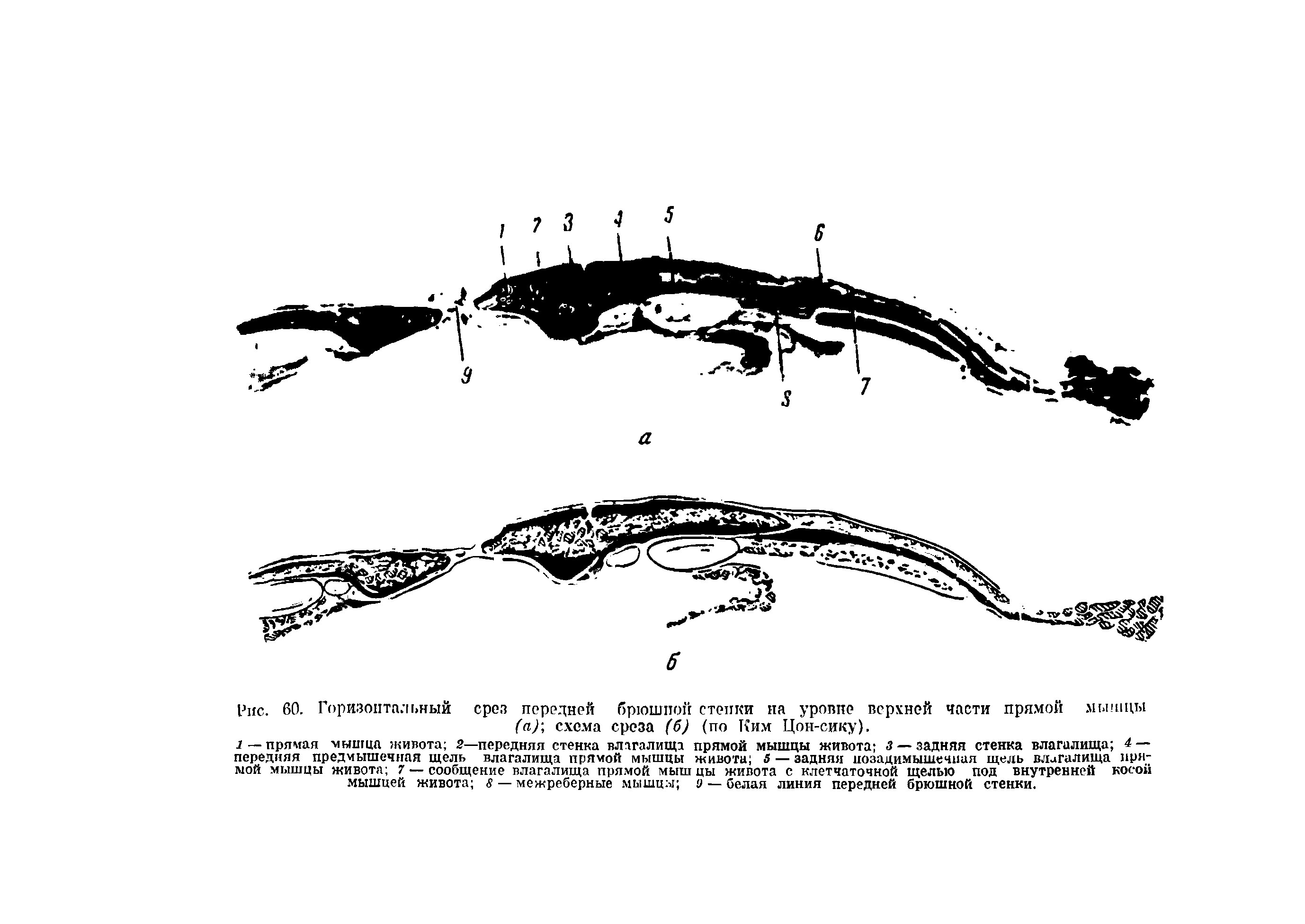 Рис. 60. Горизонтальный срез передней брюшной стенки на уровне верхней части прямой мышцы (а)-, схема среза (6) (по Ким Цон-сику).