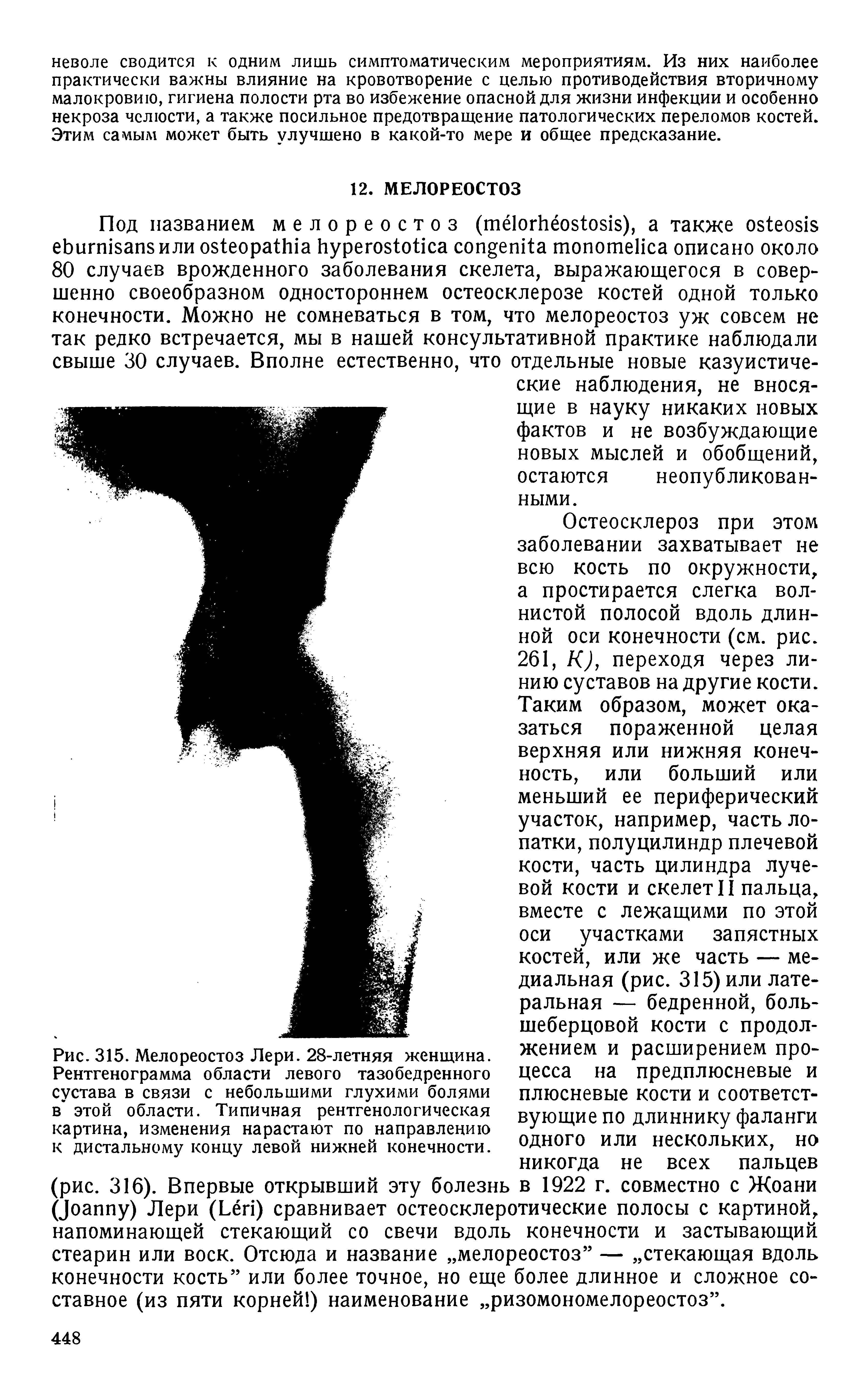 Рис. 315. Мелореостоз Лери. 28-летняя женщина. Рентгенограмма области левого тазобедренного сустава в связи с небольшими глухими болями в этой области. Типичная рентгенологическая картина, изменения нарастают по направлению к дистальному концу левой нижней конечности.