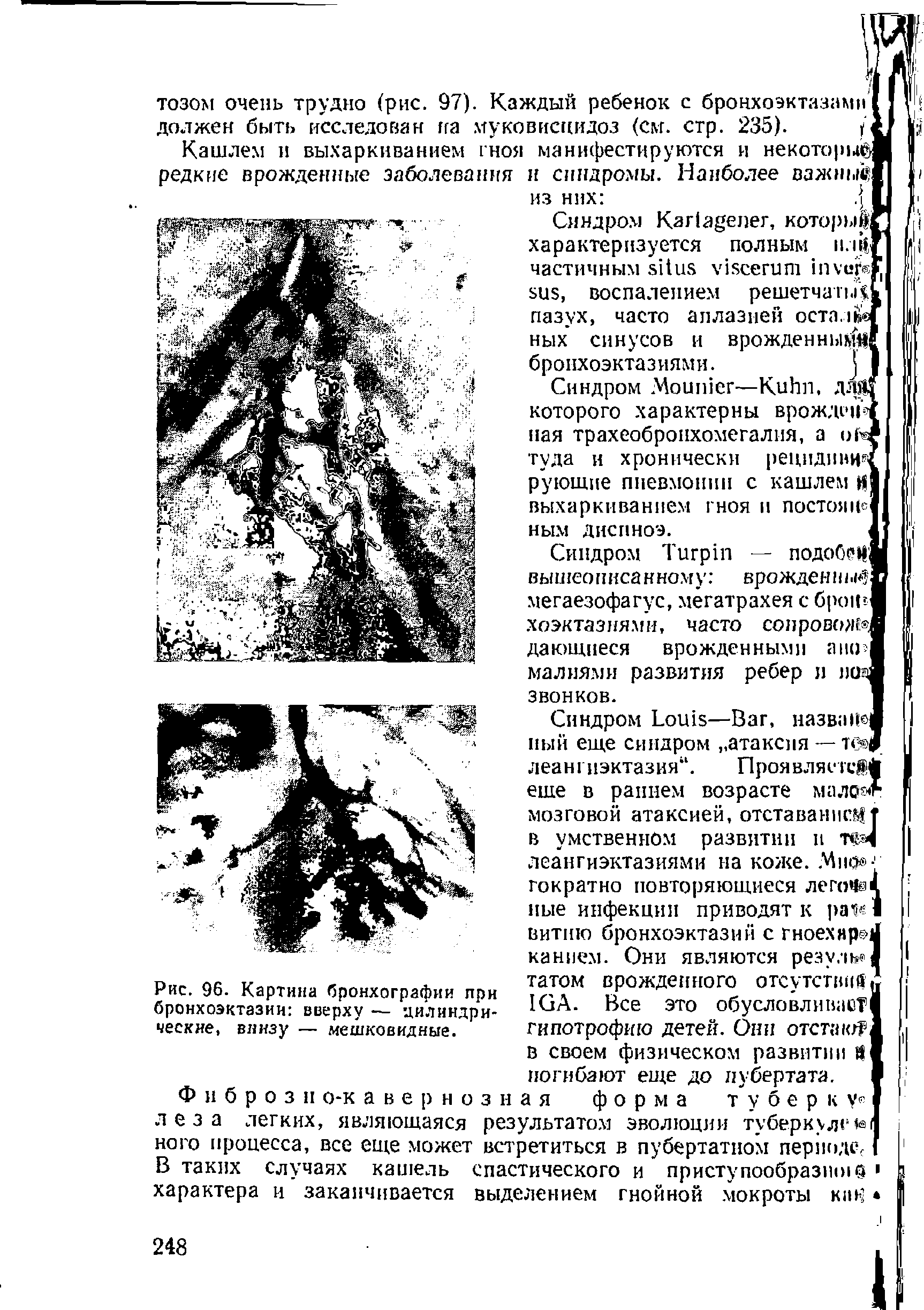 Рис. 96. Картина бронхографии при бронхоэктазии вверху — цилиндрические, внизу — мешковидные.