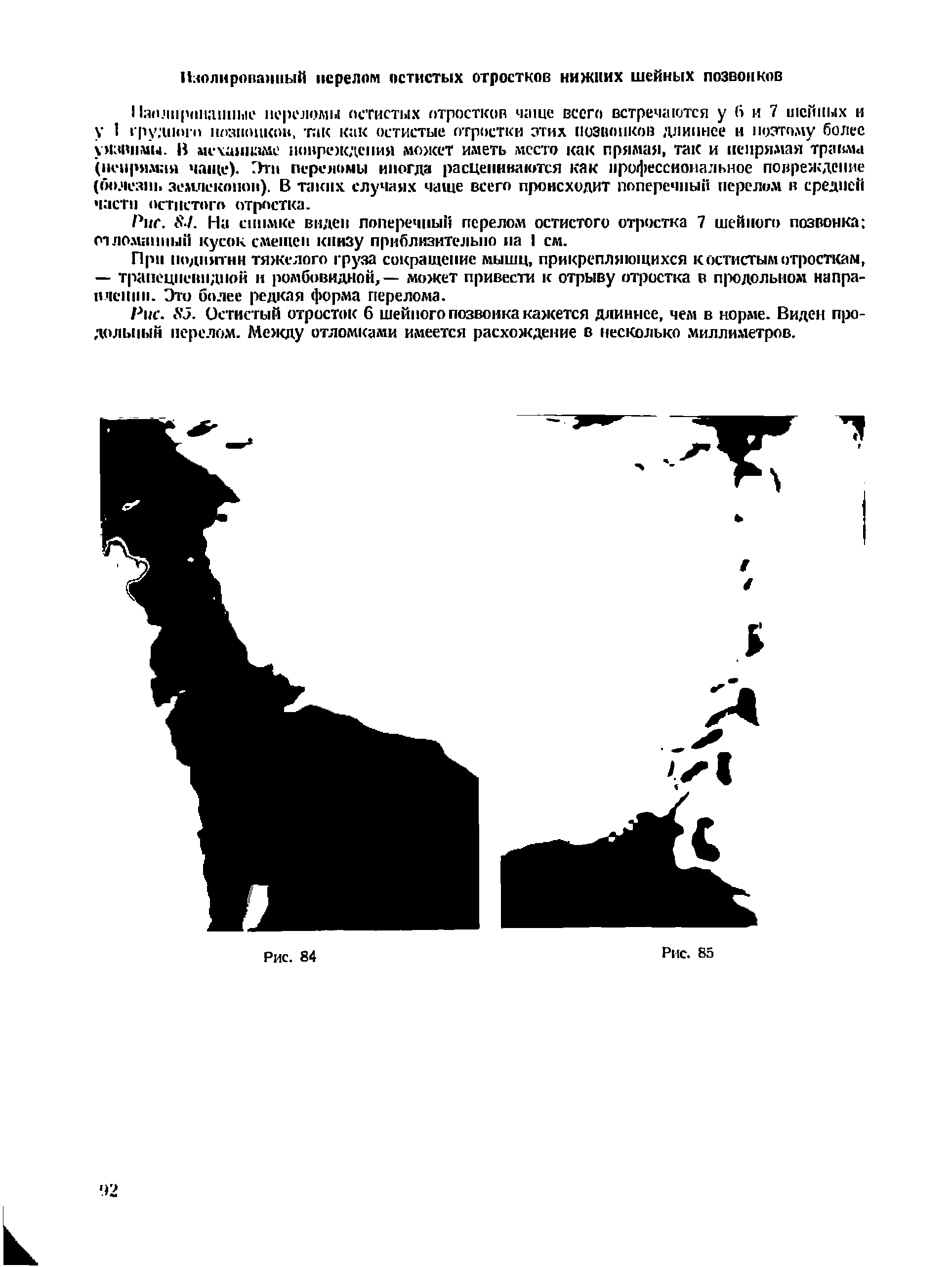 Рис. SJ. Остистый отросток 6 шейного позвонка кажется длиннее, чем в норме. Виден продольный перелом. ЛАежду отломками имеется расхождение в несколько миллиметров.