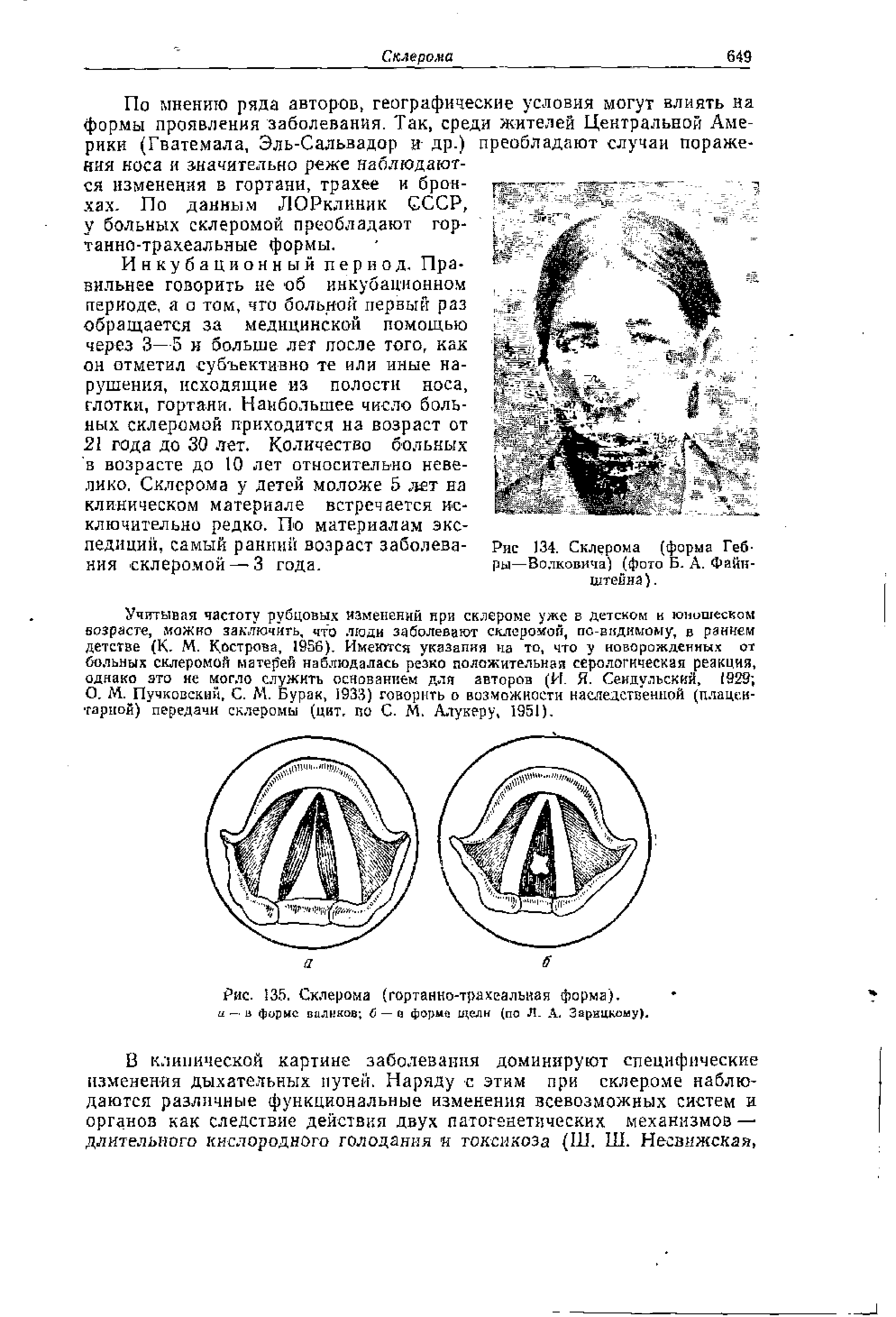 Рис. 135. Склерома (гортанно-трахеальная форма). и — в форме валинов б — в форм щели (по Л. А. Зарицкоиу).