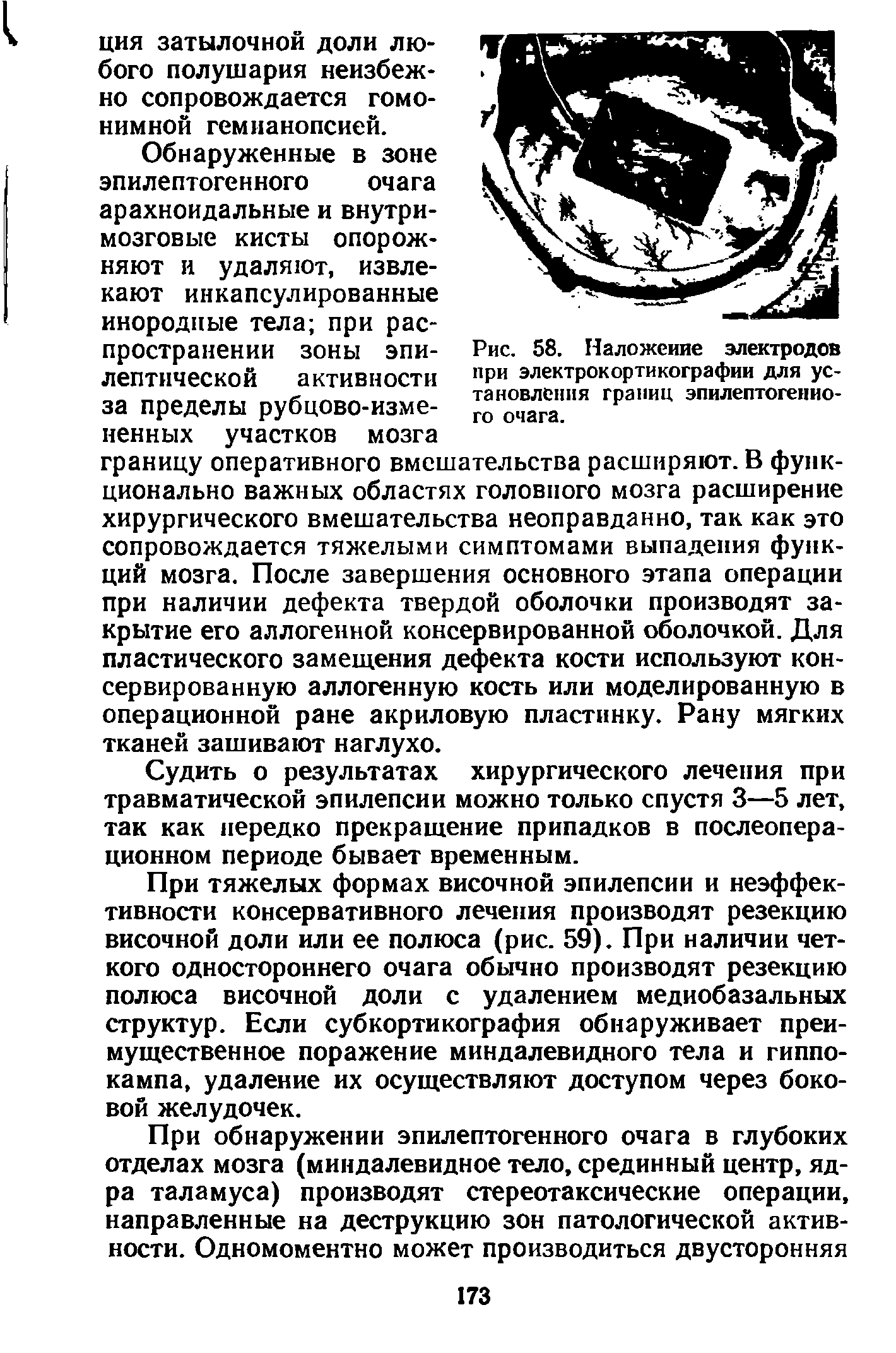 Рис. 58. Наложение электродов при электрокортикографии для установления границ эпилептогенного очага.