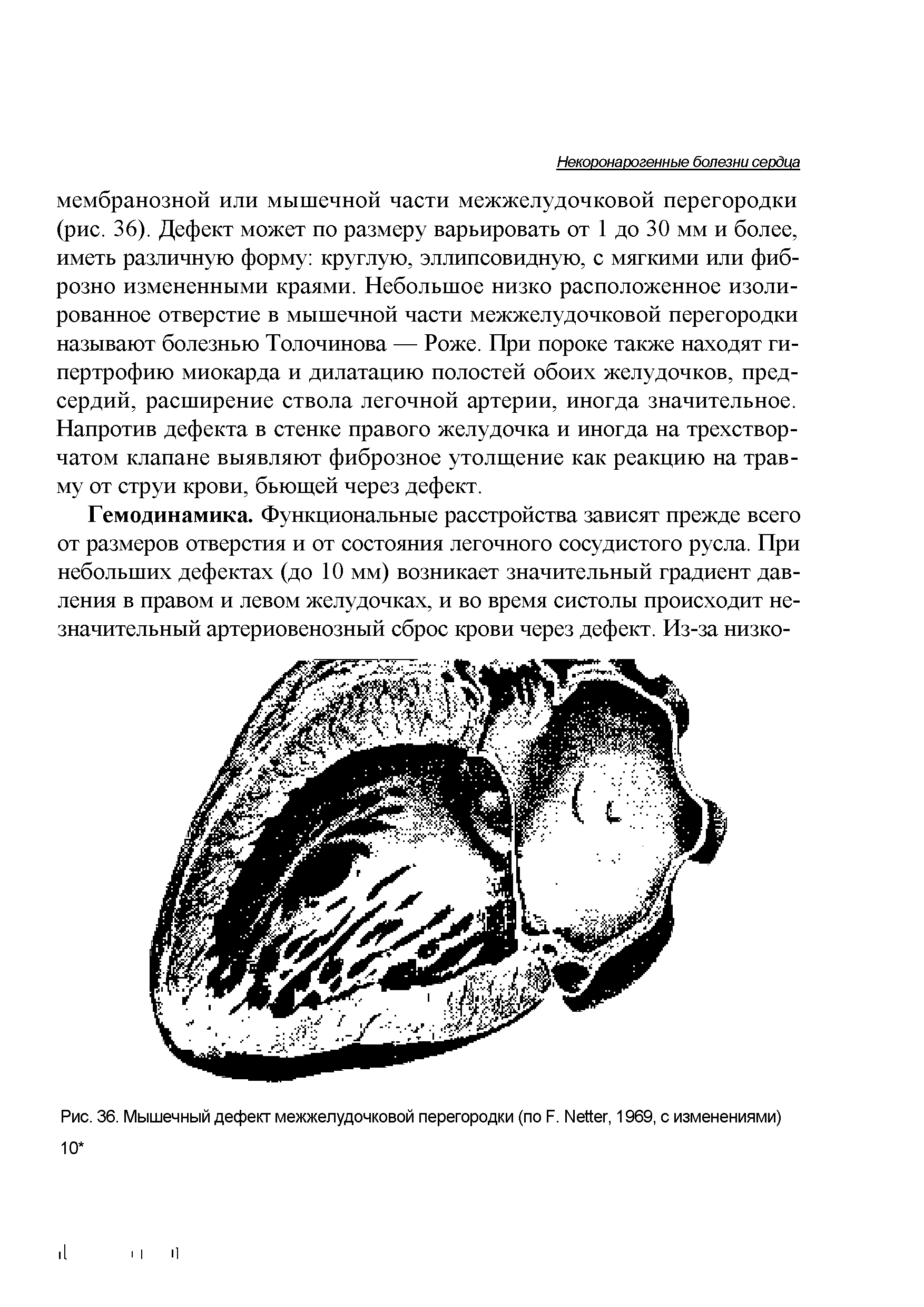 Рис. 36. Мышечный дефект межжелудочковой перегородки (по F. N , 1969, с изменениями)...