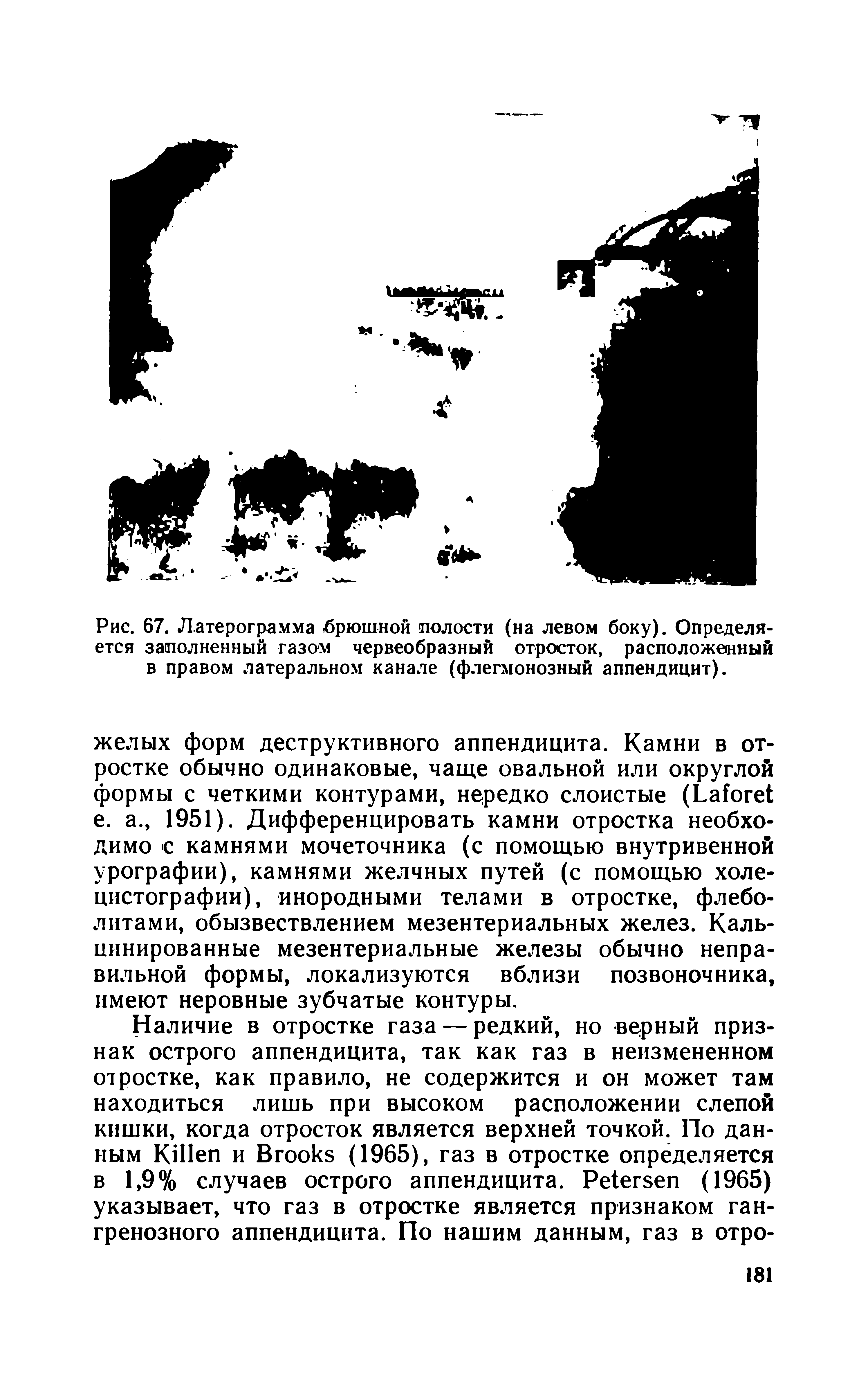 Рис. 67. Латерограмма -брюшной полости (на левом боку). Определяется заполненный газом червеобразный отросток, расположенный в правом латеральном канале (флегмонозный аппендицит).