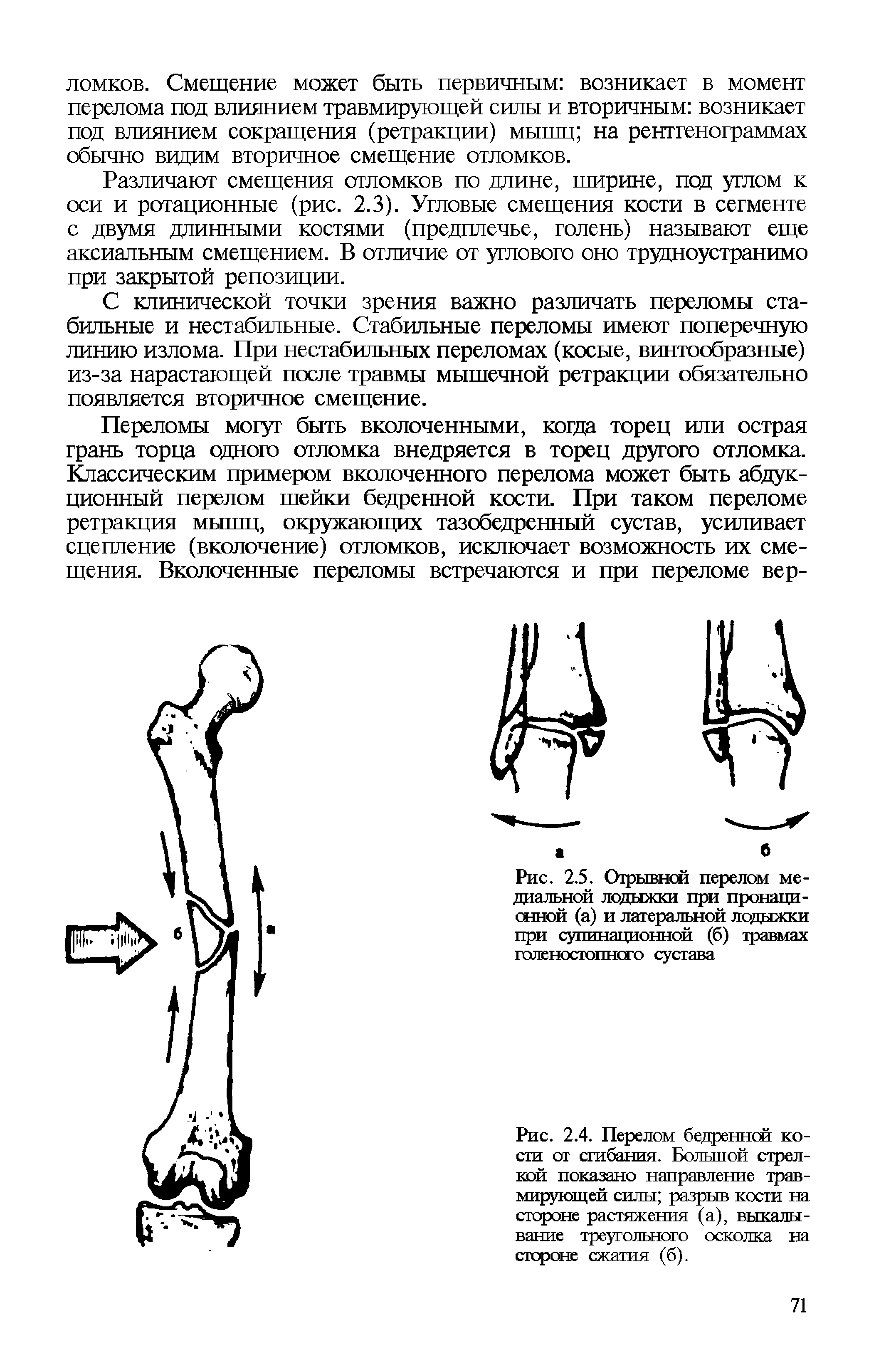 Рис. 2.5. Отрывной перелом медиальной лодыжки при пронаци-снной (а) и латеральной лодыжки при супинационной (б) травмах голеностопного сустава...