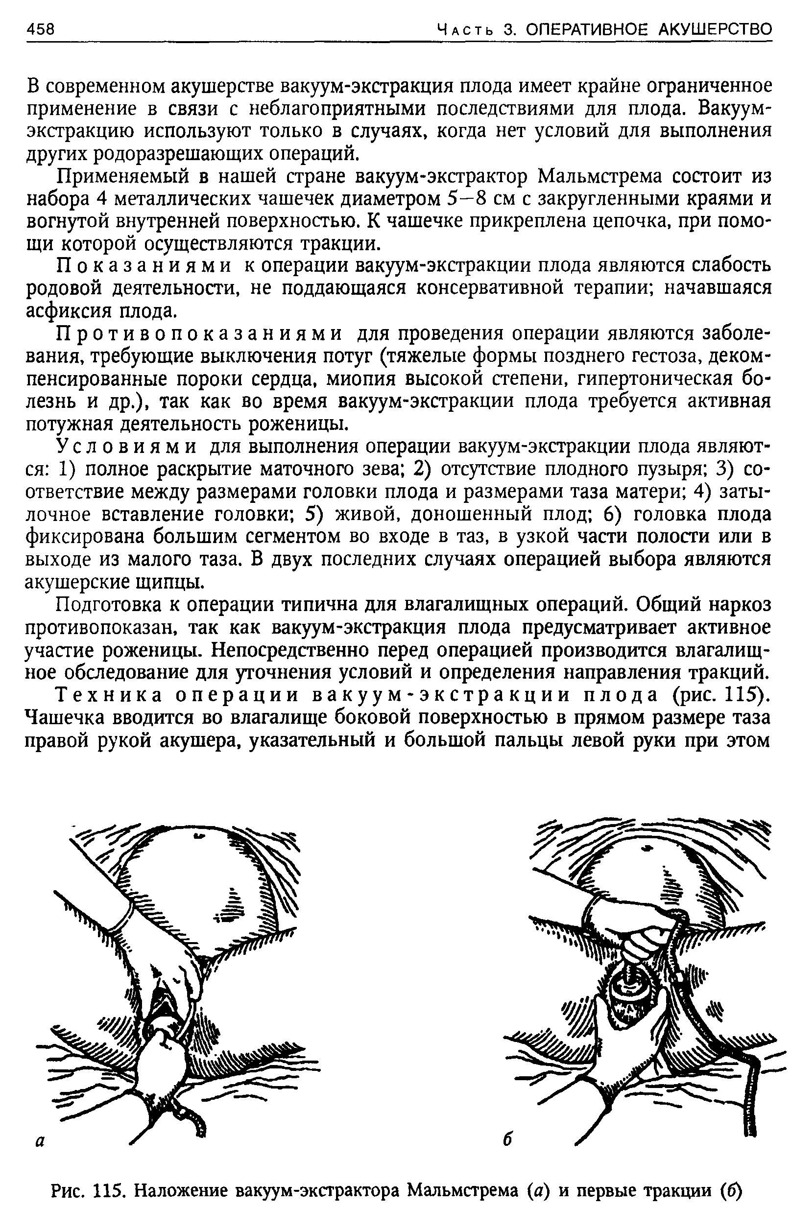 Рис. 115. Наложение вакуум-экстрактора Мальмстрема (а) и первые тракции (б)...