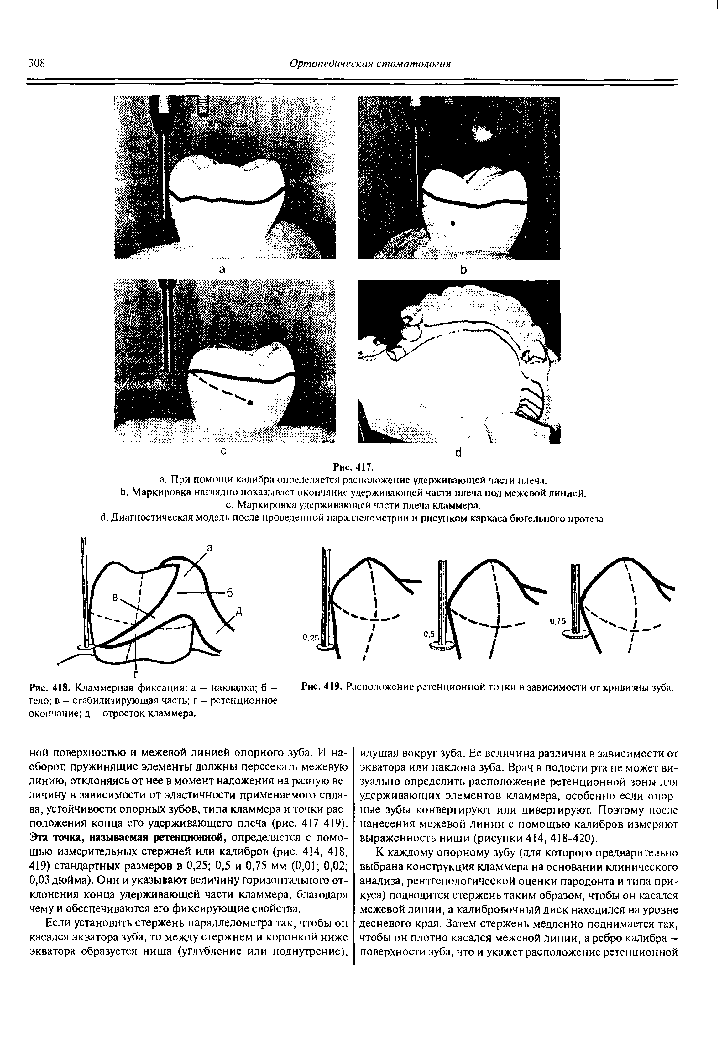 Рис. 418. Кламмерная фиксация а — накладка б -тело в - стабилизирующая часть г - ретенционное окончание д - отросток кламмера.