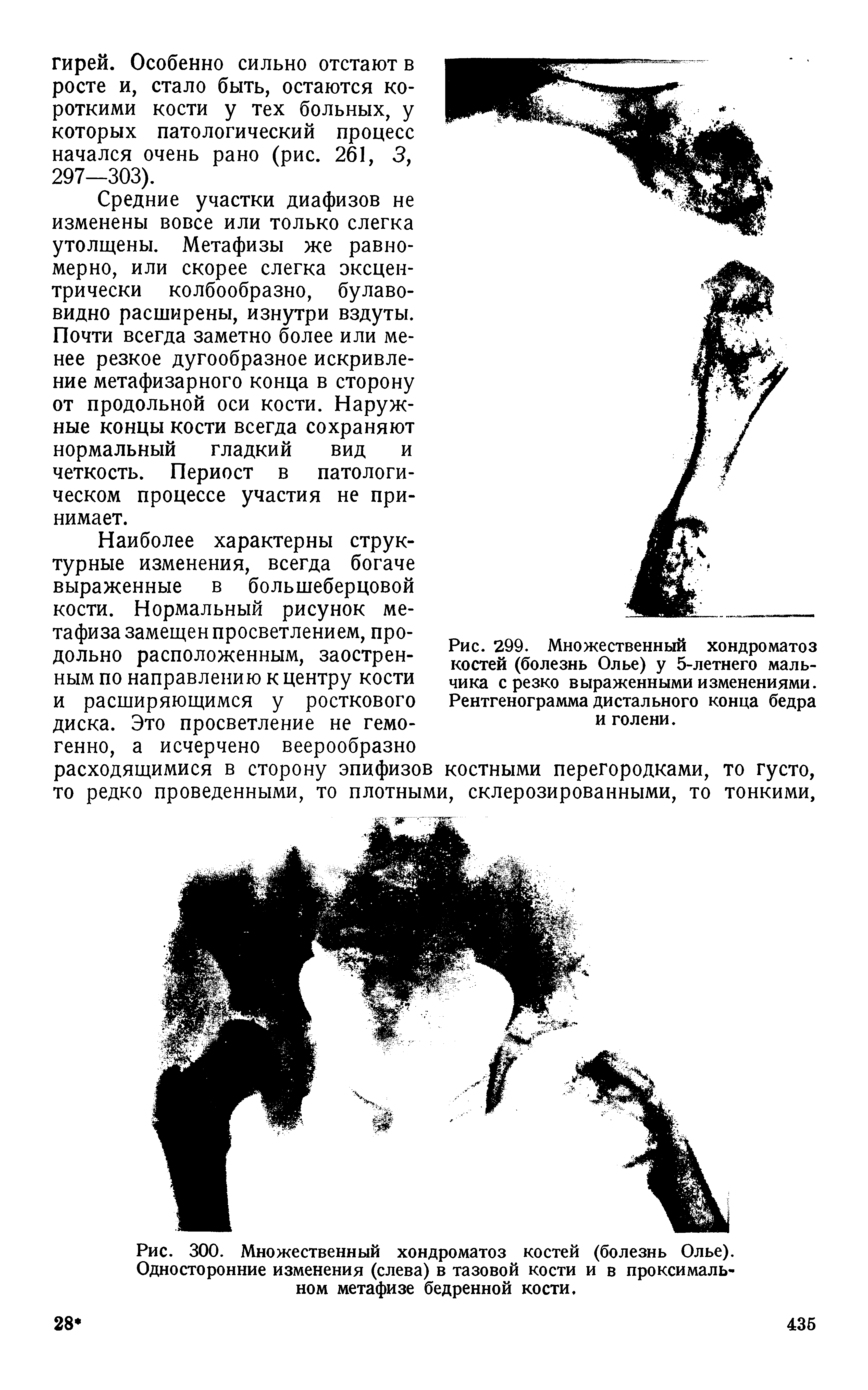 Рис. 300. Множественный хондроматоз костей (болезнь Олье). Односторонние изменения (слева) в тазовой кости и в проксимальном метафизе бедренной кости.