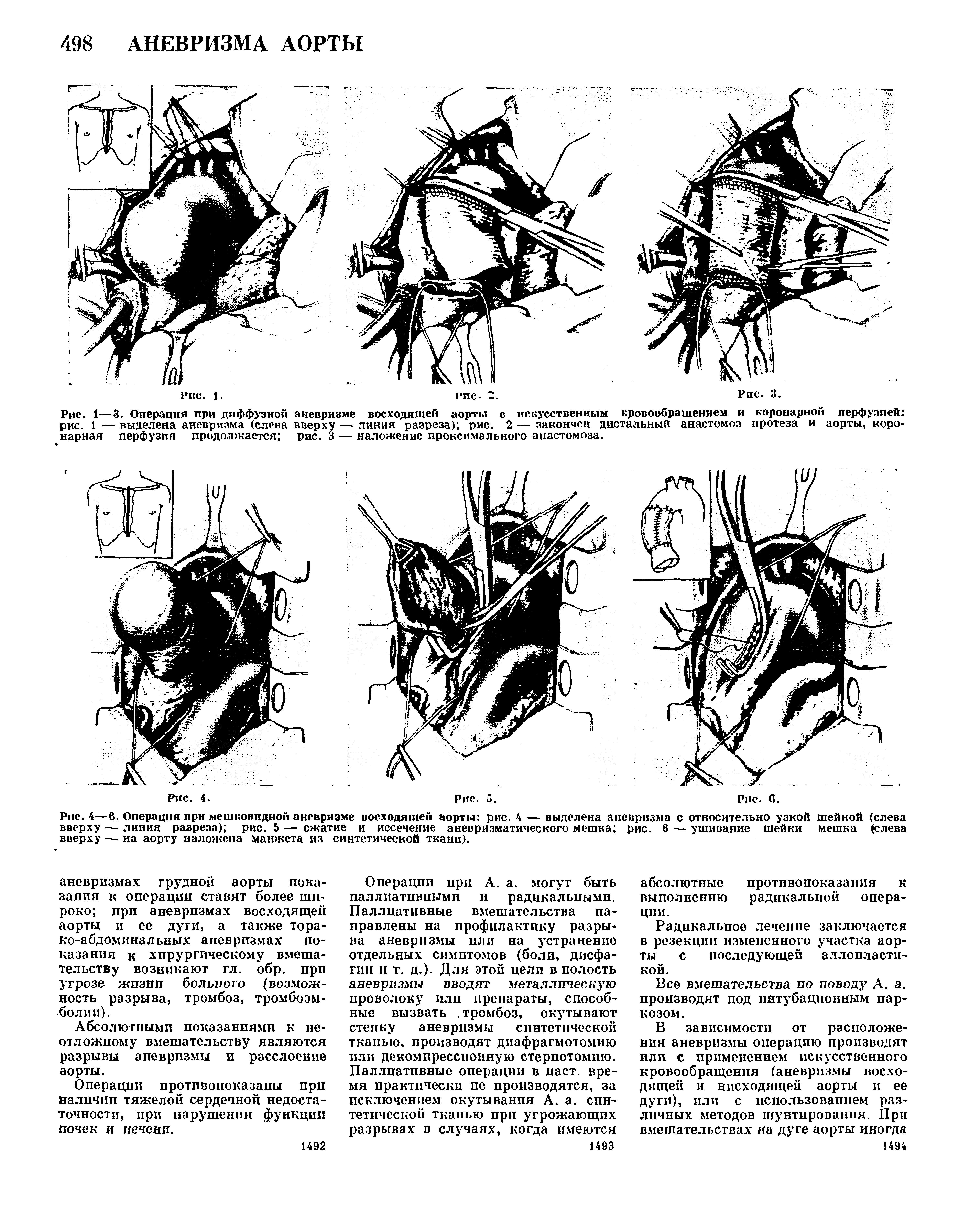 Рис. 1—3. Операция при диффузной аневризме восходящей аорты с искусственным кровообращением и коронарной перфузией рис. 1 — выделена аневризма (слева вверху — линия разреза) рис. 2 — закончен дистальный анастомоз протеза и аорты, коронарная перфузия продолжается рис. 3 — наложение проксимального анастомоза.