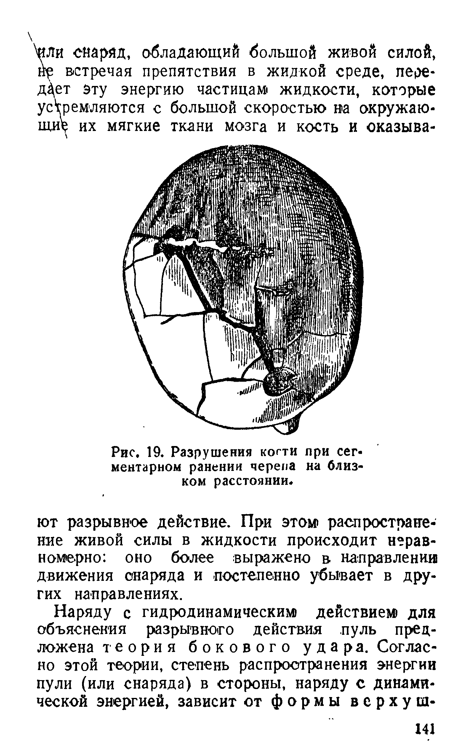 Рис. 19. Разрушения кости при сегментарном ранении черепа на близком расстоянии.