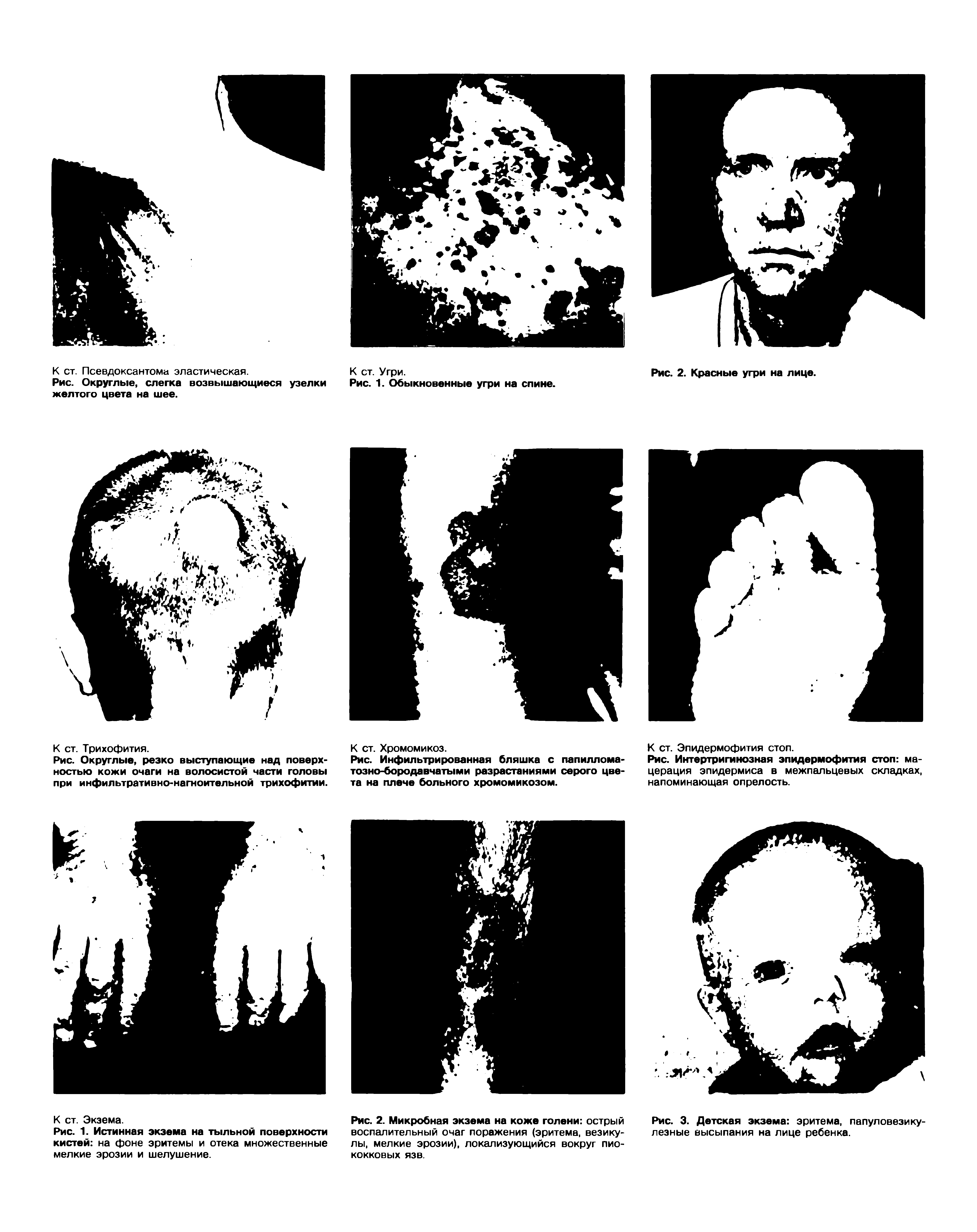 Рис. Интертригинозная эпидермофития стоп мацерация эпидермиса в межпальцевых складках, напоминающая опрелость.