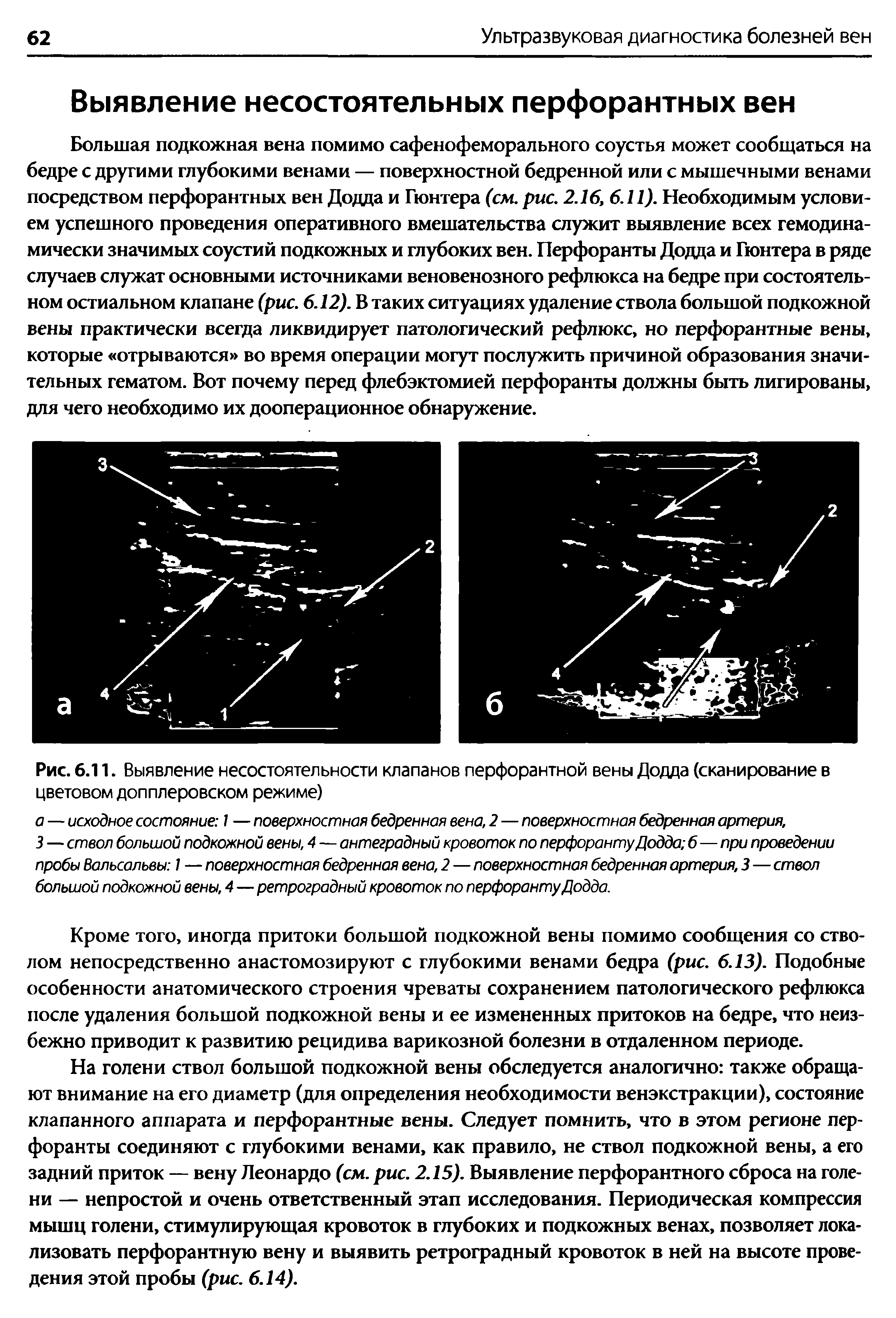 Рис. 6.11. Выявление несостоятельности клапанов перфорантной вены Додда (сканирование в цветовом допплеровском режиме)...