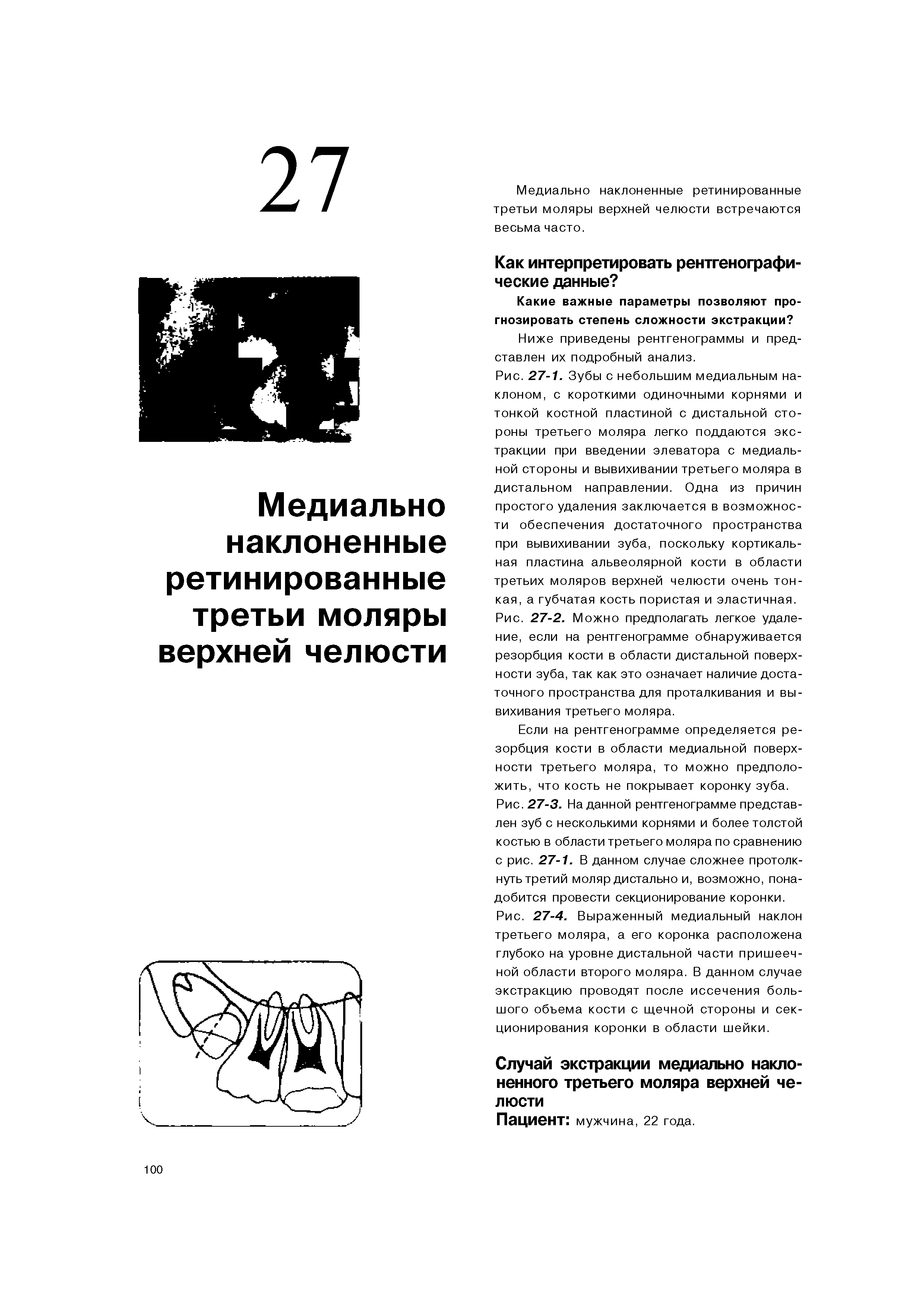 Рис. 27-2. Можно предполагать легкое удаление, если на рентгенограмме обнаруживается резорбция кости в области дистальной поверхности зуба, так как это означает наличие достаточного пространства для проталкивания и вывихивания третьего моляра.