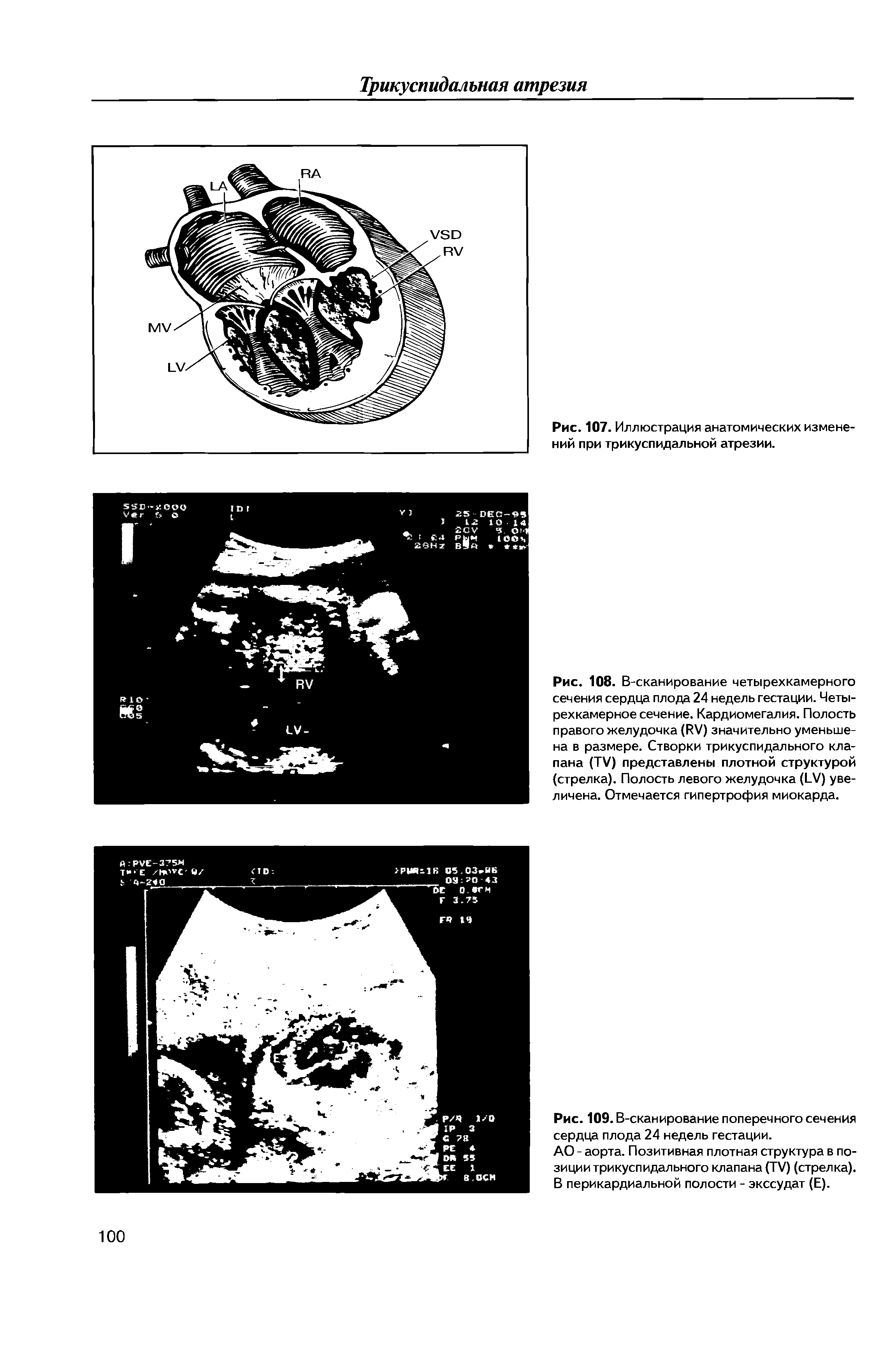 Рис. 108. В-сканирование четырехкамерного сечения сердца плода 24 недель гестации. Четырехкамерное сечение. Кардиомегалия. Полость правого желудочка (РУ) значительно уменьшена в размере. Створки трикуспидального клапана (ТУ) представлены плотной структурой (стрелка). Полость левого желудочка ( У) увеличена. Отмечается гипертрофия миокарда.