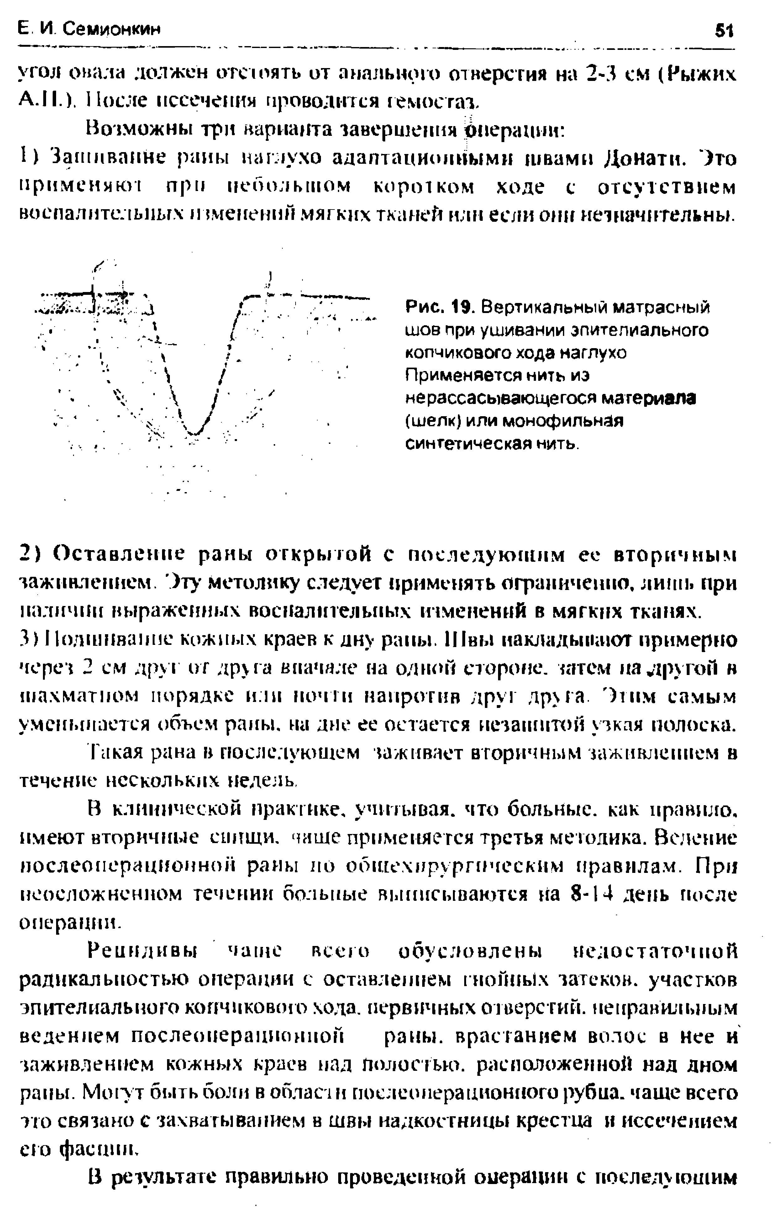 Рис. 19. Вертикальный матрасный шов при ушивании эпителиального копчикового хода наглухо Применяется нить иэ не рассасывающегося материала (шелк) или монофильнйя синтетическая нить.