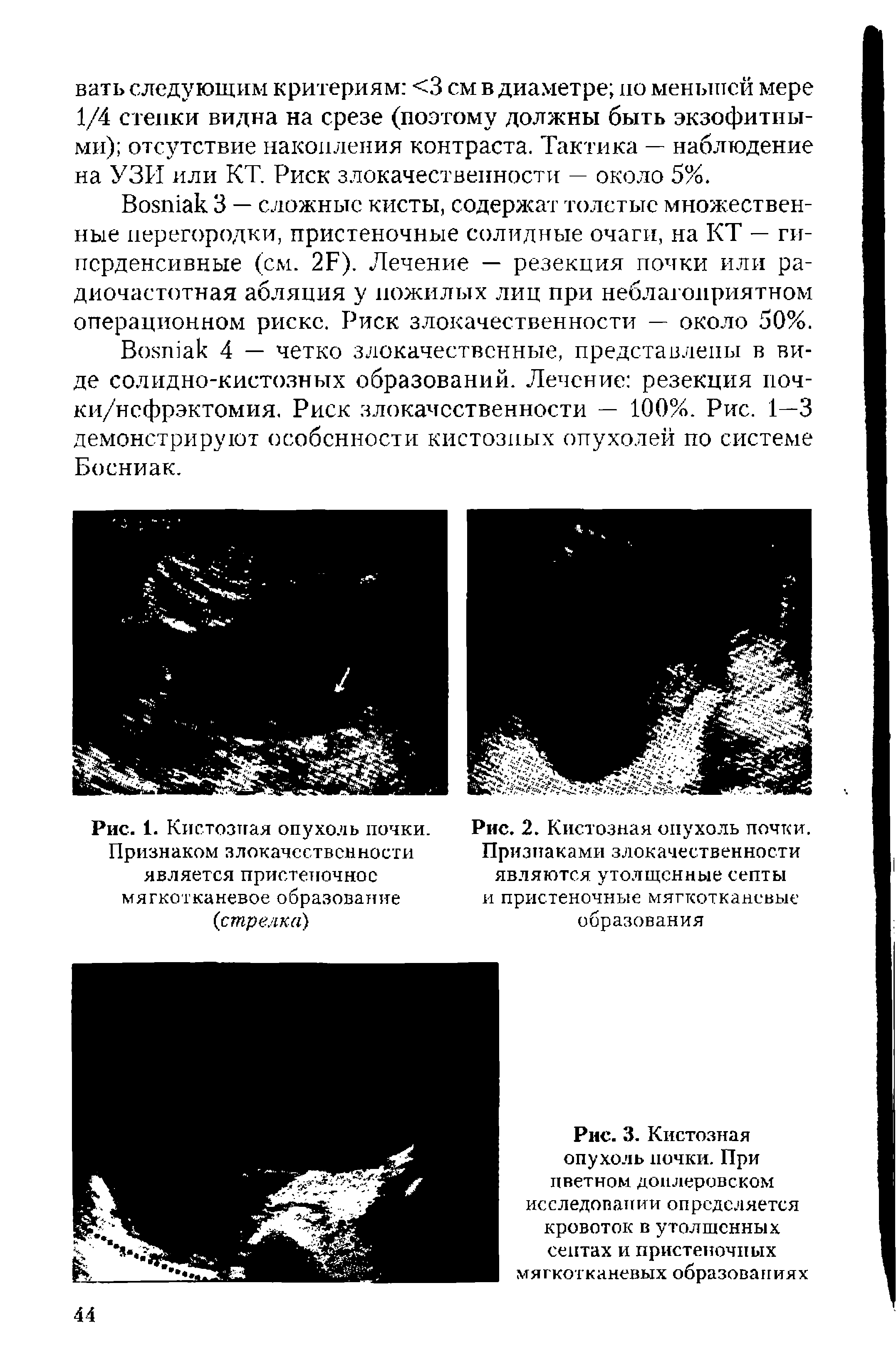 Рис. 3. Кистозная опухоль почки. При цветном доплеровском исследовании определяется кровоток в утолщенных сентах и пристеночных мягкотканевых образованиях...