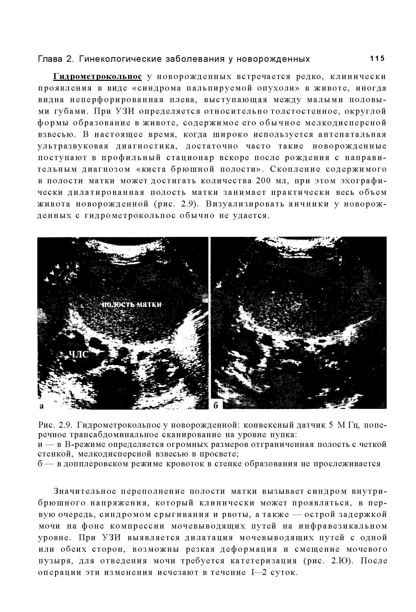 Рис. 2.9. Гидрометрокольпос у новорожденной конвексный датчик 5 МГц, поперечное трансабдоминальное сканирование на уровне пупка ...