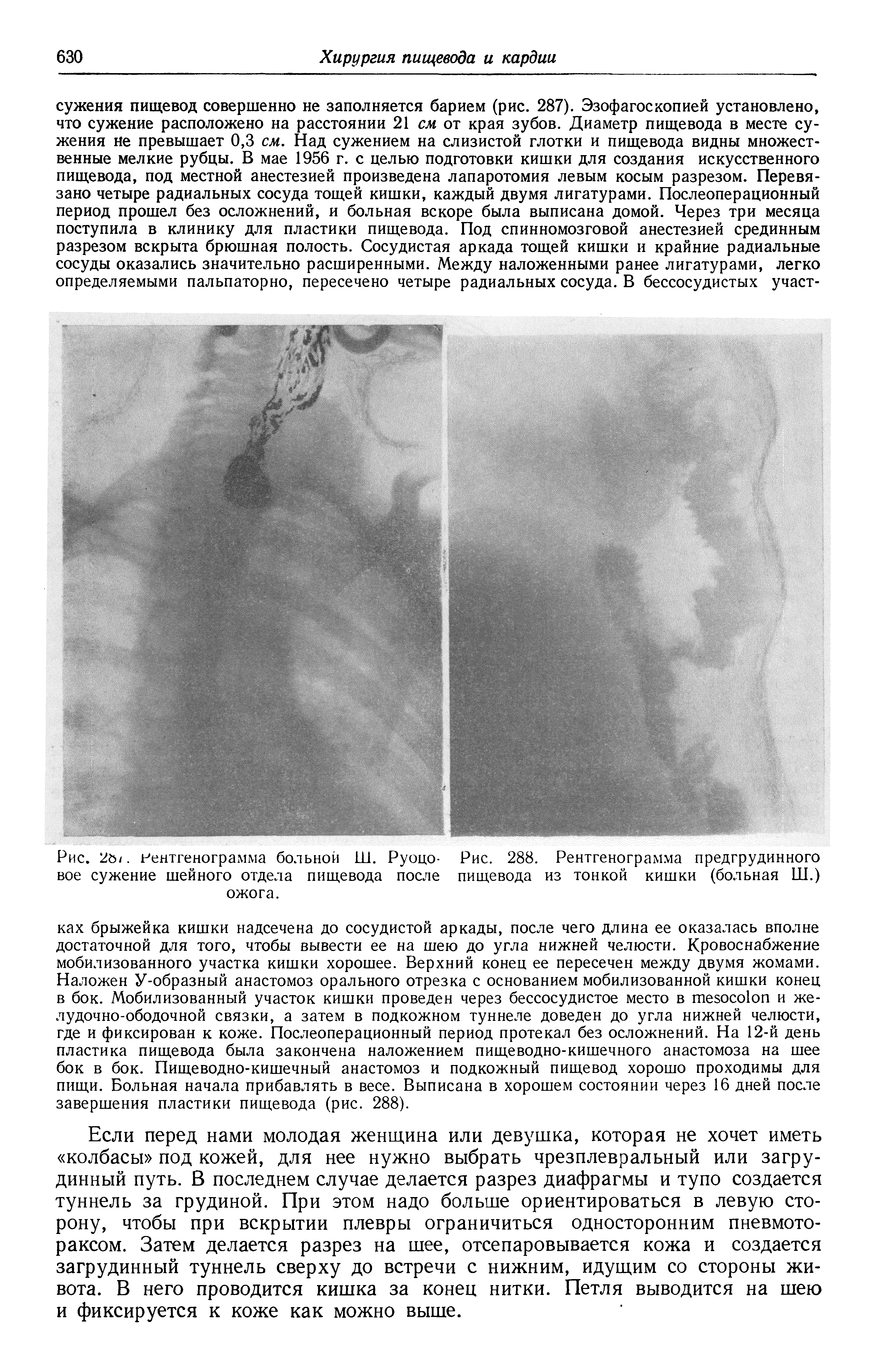 Рис. 2 /. Рентгенограмма больной Ш. Руоцо- Рис. 288. Рентгенограмма предгрудинного вое сужение шейного отдела пищевода после пищевода из тонкой кишки (больная Ш.) ожога.