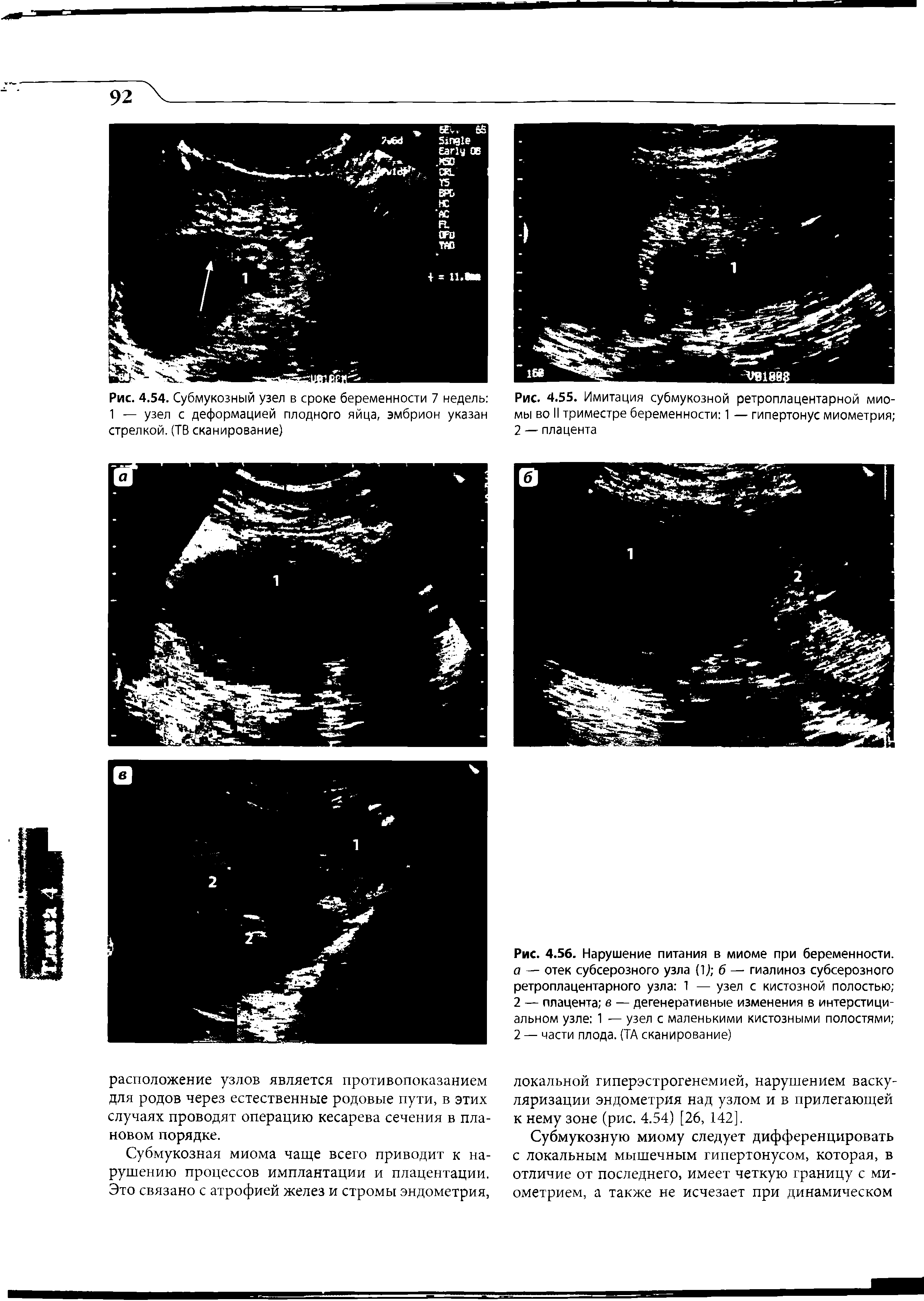 Рис. 4.56. Нарушение питания в миоме при беременности. а — отек субсерозного узла (1) б — гиалиноз субсерозного ретроплацентарного узла 1 — узел с кистозной полостью 2 — плацента в — дегенеративные изменения в интерстициальном узле 1 — узел с маленькими кистозными полостями 2 — части плода. (ТА сканирование)...