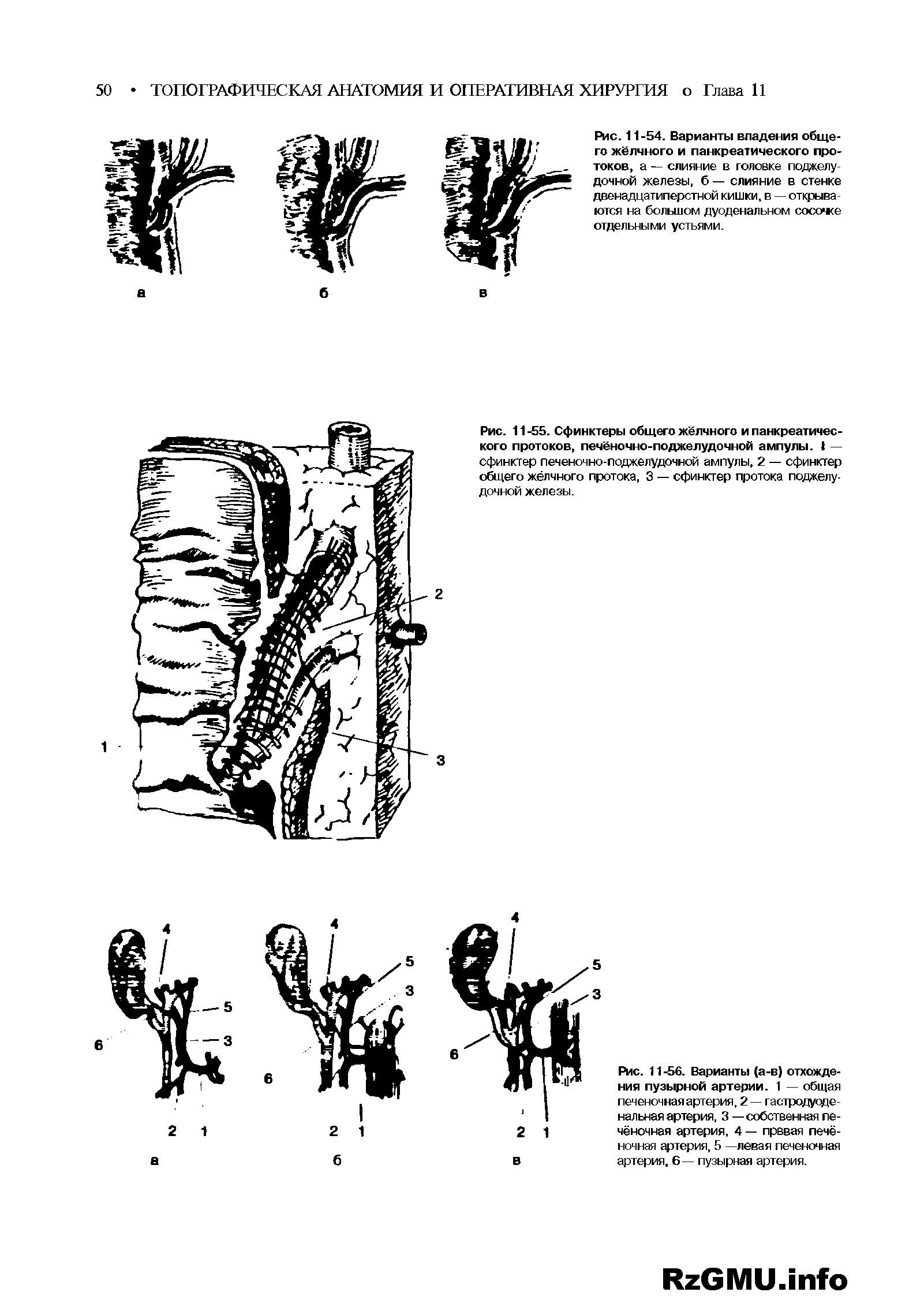 Рис. 11 -56. Варианты (а-в) отхождения пузырной артерии. 1 — общая печеночная артерия, 2 — гастродуоденальная артерия, 3 — собственная печёночная артерия, 4 — прввая печёночная артерия, 5 —левая печеночная артерия, 6— пузырная артерия.