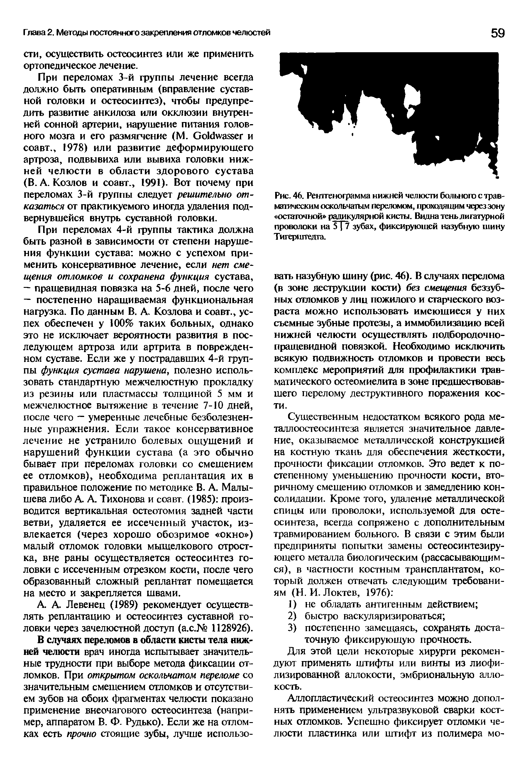 Рис. 46. Рентгенограмма нижней челюсти больного с травматическим оскольчатым переломом, проходящим через зону остаточной радикулярной кисты. Видна тень лигатурной проволоки на 5 7 зубах, фиксирующей назубную шину Тигериггелта.