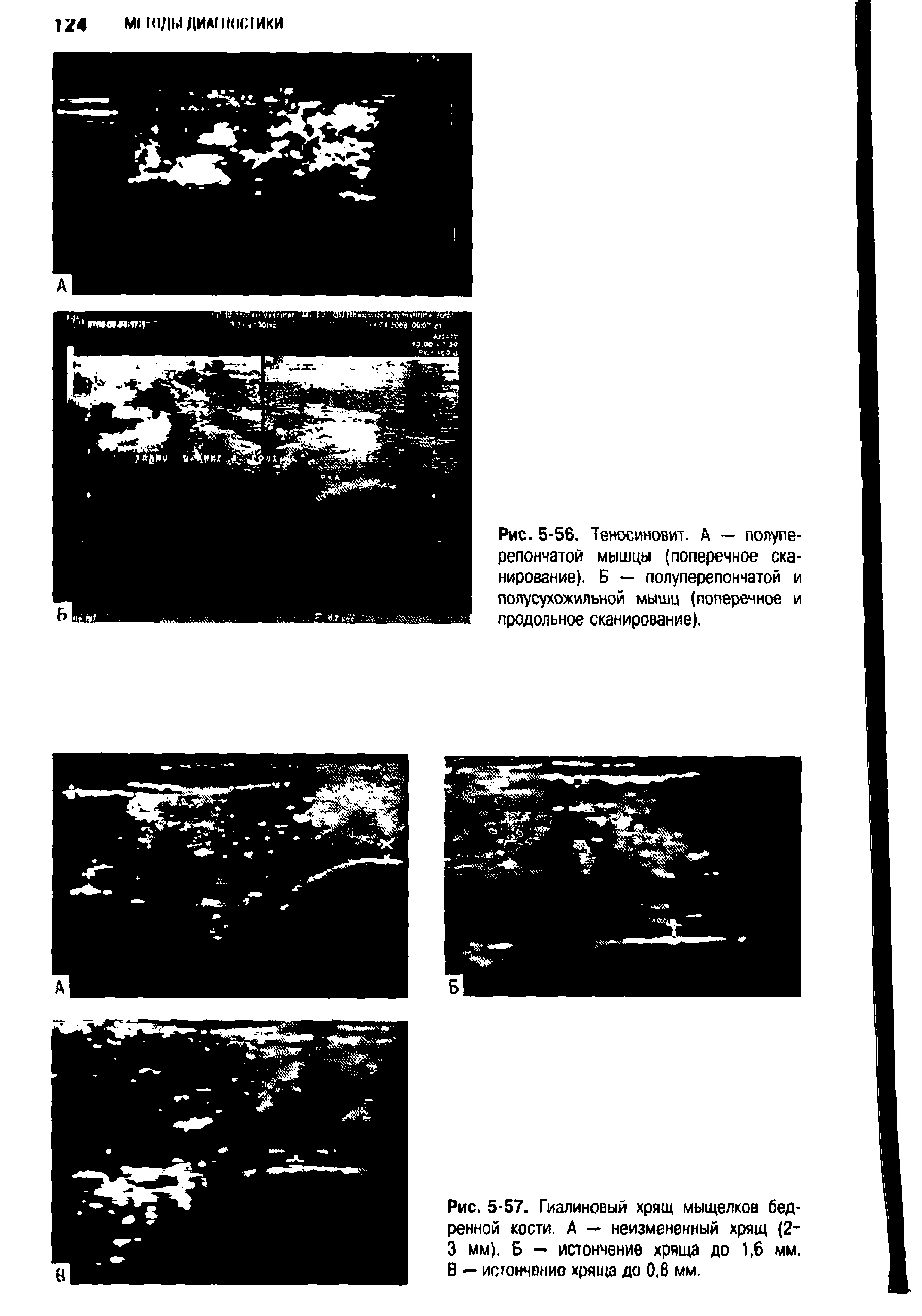 Рис. 5-56. Теносиновит. А — полупе-репончатой мышцы (поперечное сканирование). Б — полуперепончатой и полусухожильной мышц (поперечное и продольное сканирование).