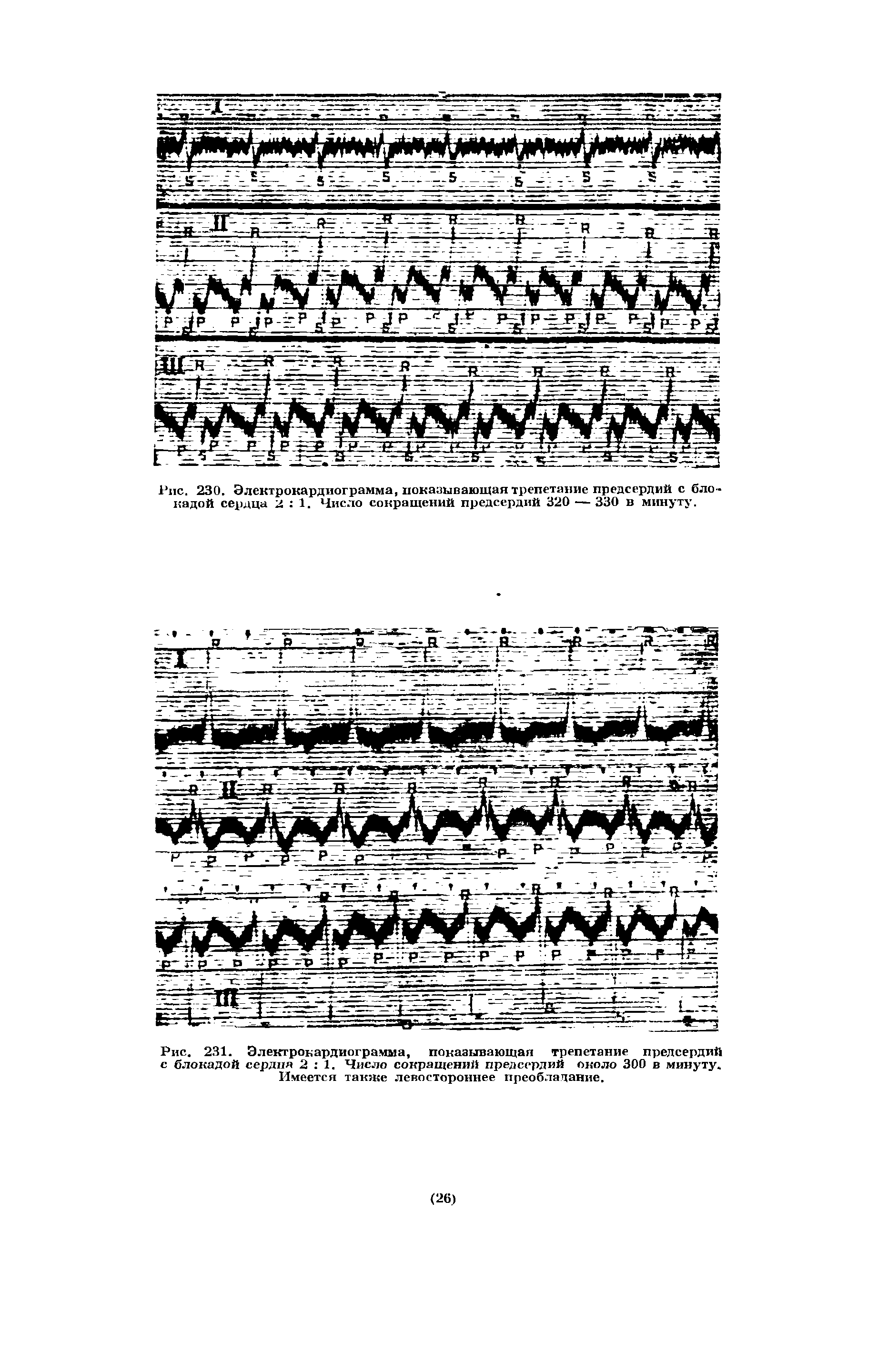 Рис. 230. Электрокардиограмма, показывающая трепетание предсердий с бло кадой сердца 2 1. Число сокращений предсердий 320 — 330 в минуту.
