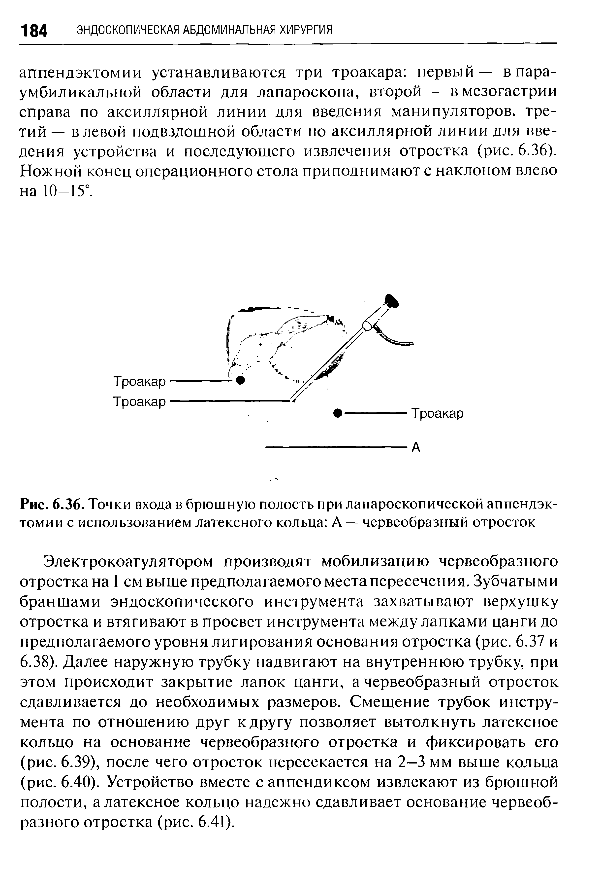 Рис. 6.36. Точки входа в брюшную полость при лапароскопической аппендэктомии с использованием латексного кольца А — червеобразный отросток...