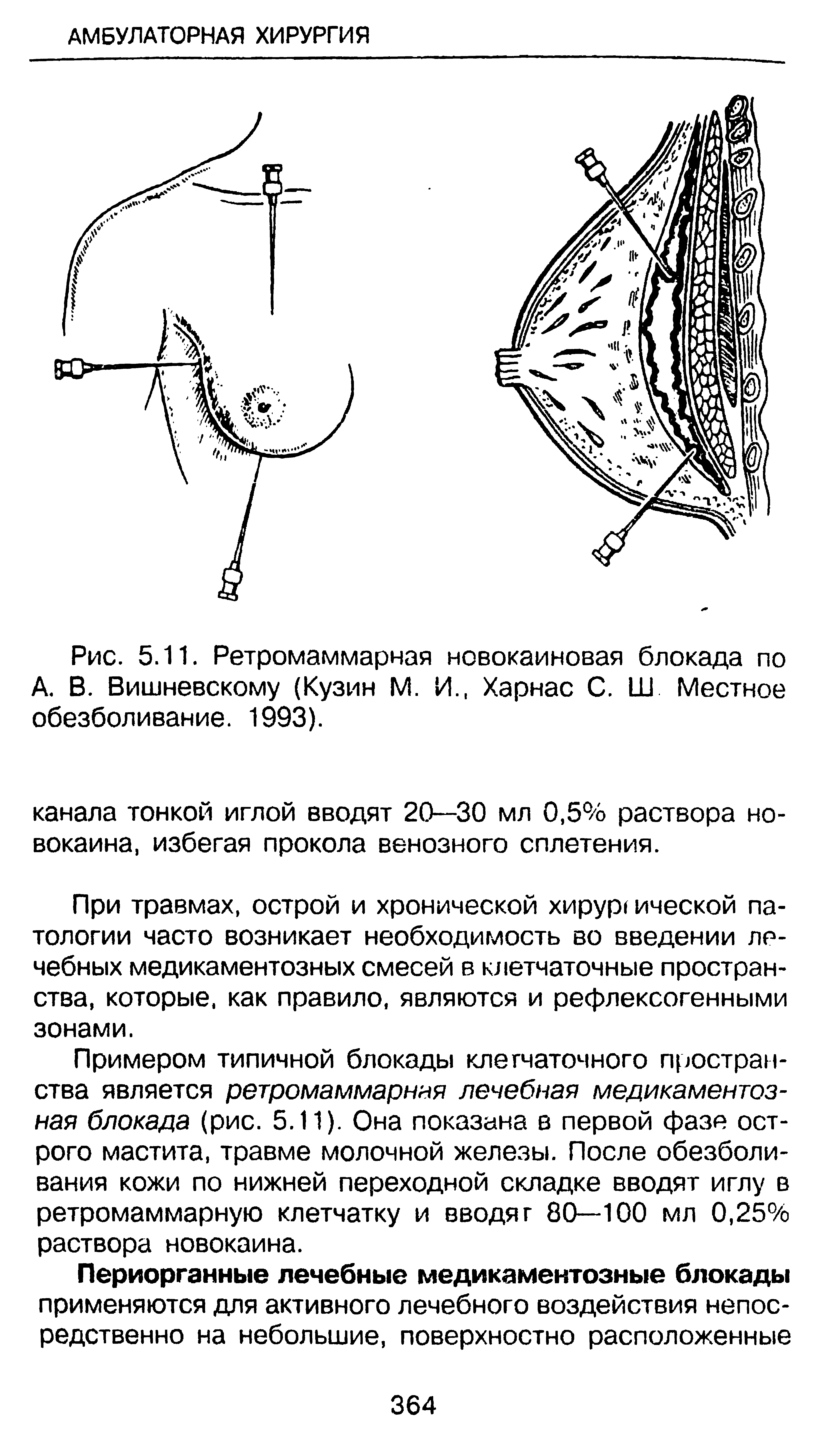 Рис. 5.11. Ретромаммарная новокаиновая блокада по А. В. Вишневскому (Кузин М. И., Харнас С. Ш Местное обезболивание. 1993).