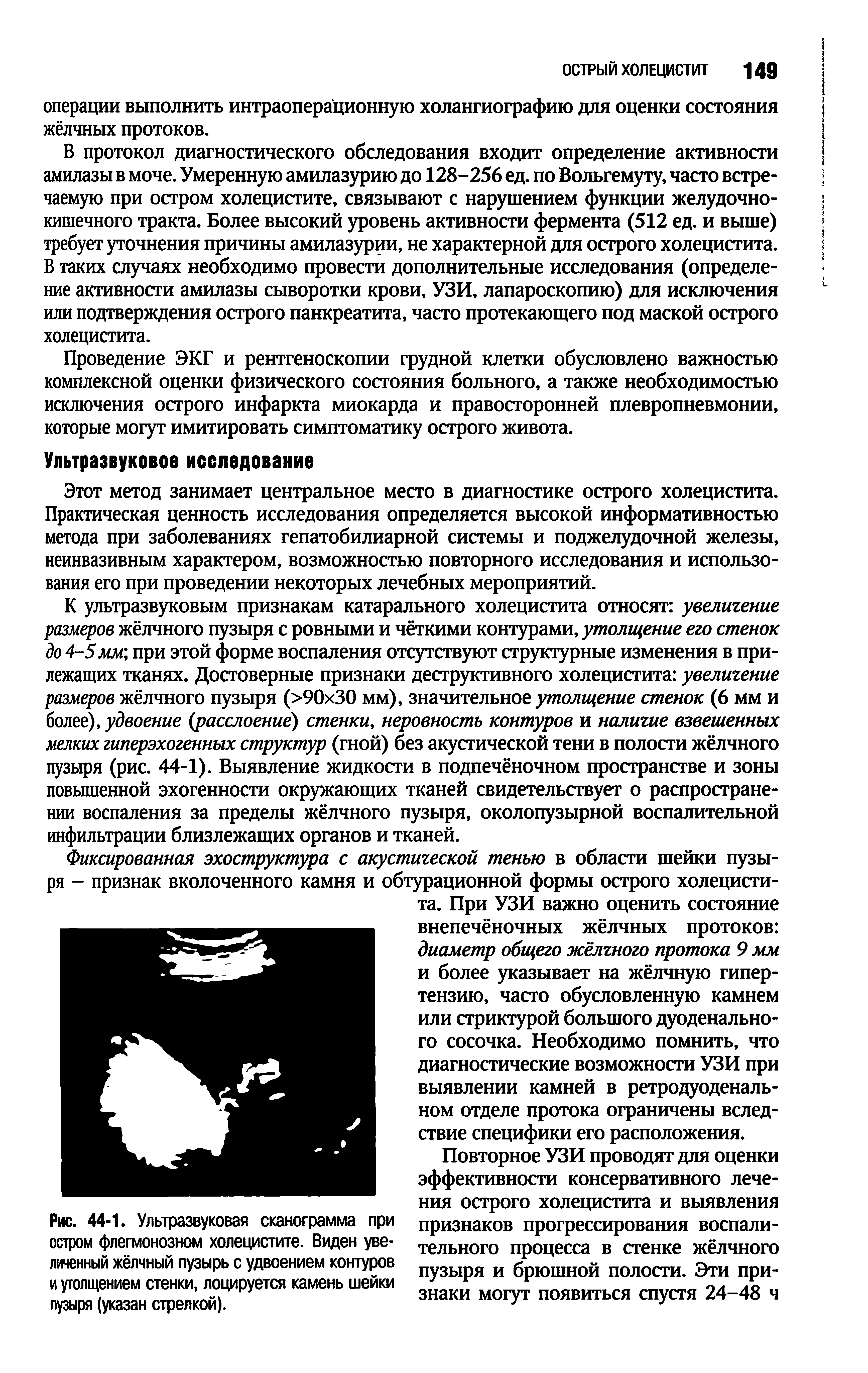 Рис. 44-1. Ультразвуковая сканограмма при остром флегмонозном холецистите. Виден увеличенный жёлчный пузырь с удвоением контуров и утолщением стенки, лоцируется камень шейки пузыря (указан стрелкой).