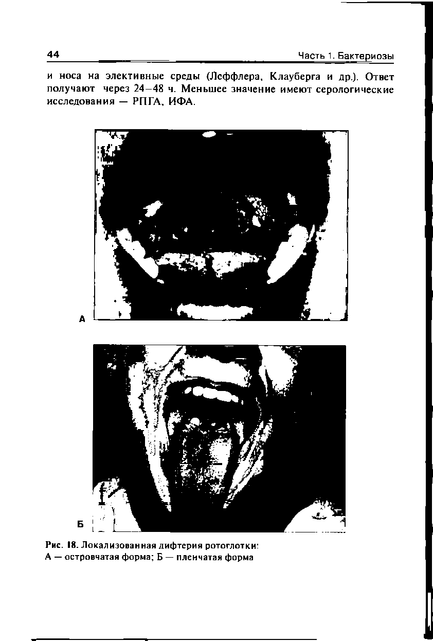 Рис. 18. Локализованная дифтерия ротоглотки А — островчатая форма Б — пленчатая форма...