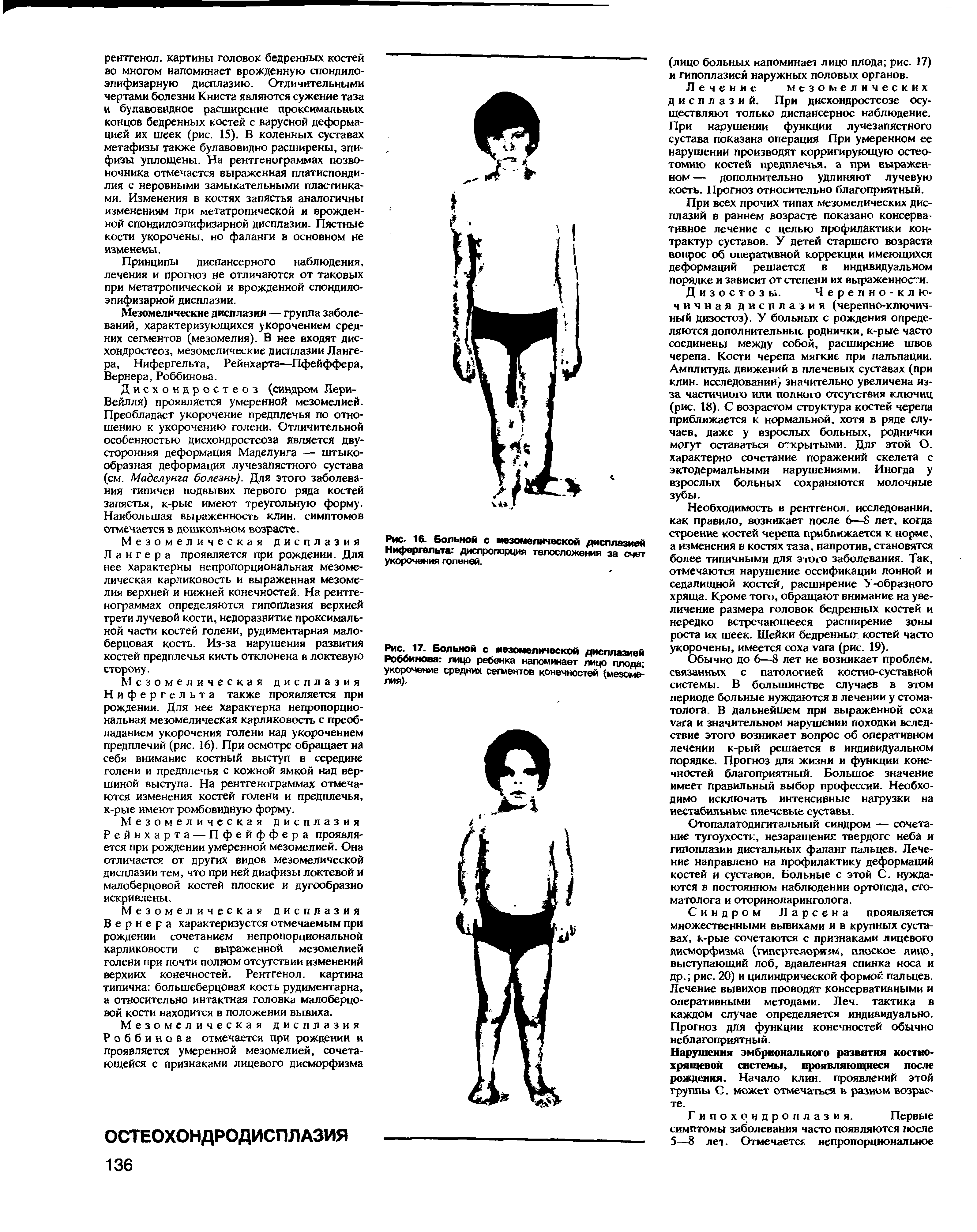 Рис. 17. Больной с мезомелической дисплазией Роббинова лицо ребенка напоминает лицо плода-укорочение средних сегменте конечностей (мезомеь лия).