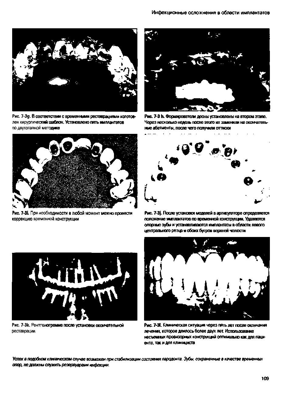 Рис. 7-Зд. В соответств с времен реставрациями изготовлен хирургический шаблон. Остановлено пять имплантатов по двухэтапной методике...