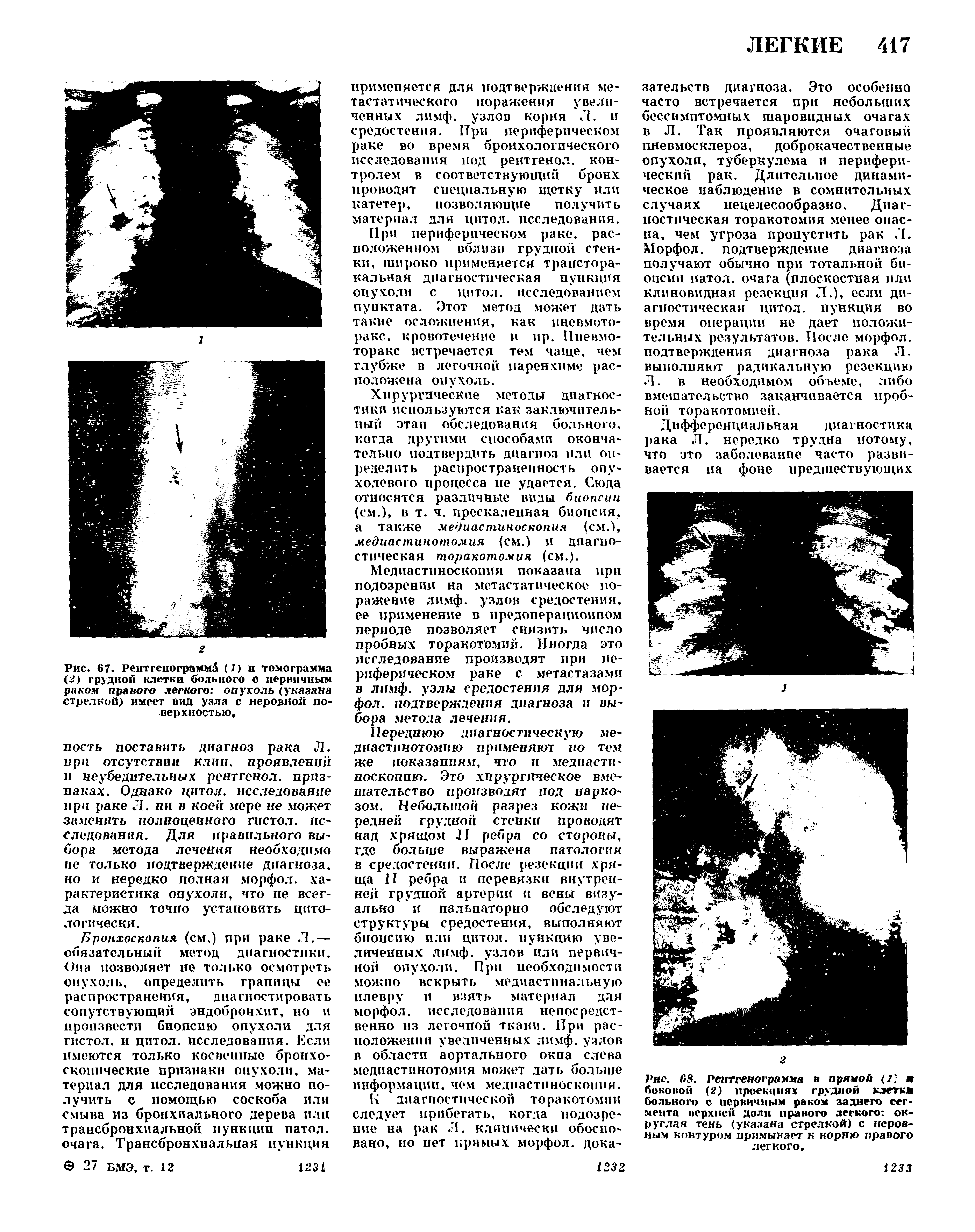 Рис. 67. Рентгенограмм (7) и томограмма < ) грудной клетки больного с первичным раком правого легкого опухоль (указана стрелкой) имеет вид узла с неровной поверхностью.