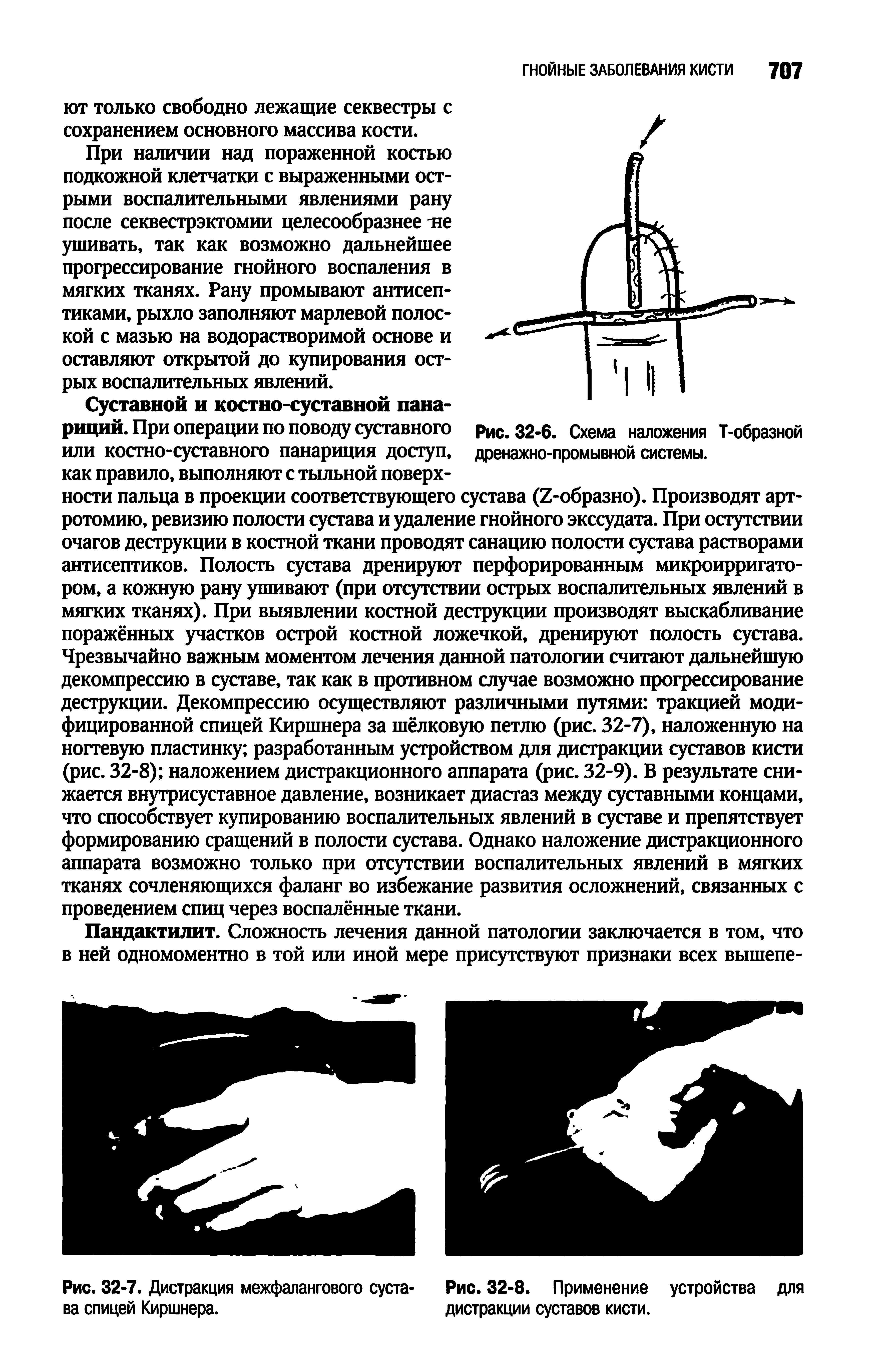 Рис. 32-6. Схема наложения Т-образной дренажно-промывной системы.