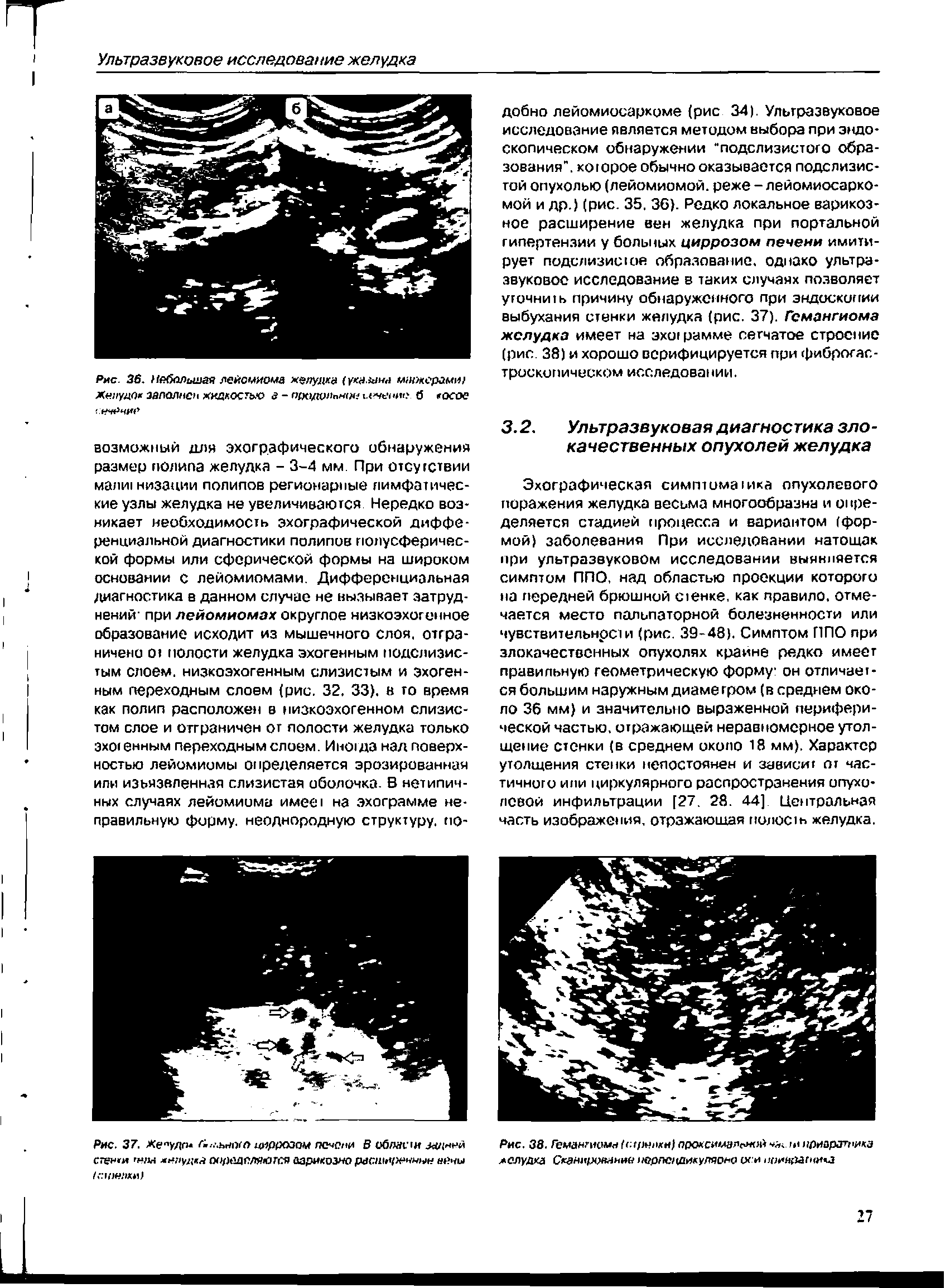 Рис. 36. Небольшая лейомиома желудка (указана мыжсрамш Жннудо заполнен жидкостью а - подгрлпягж (.< < №. б осое...