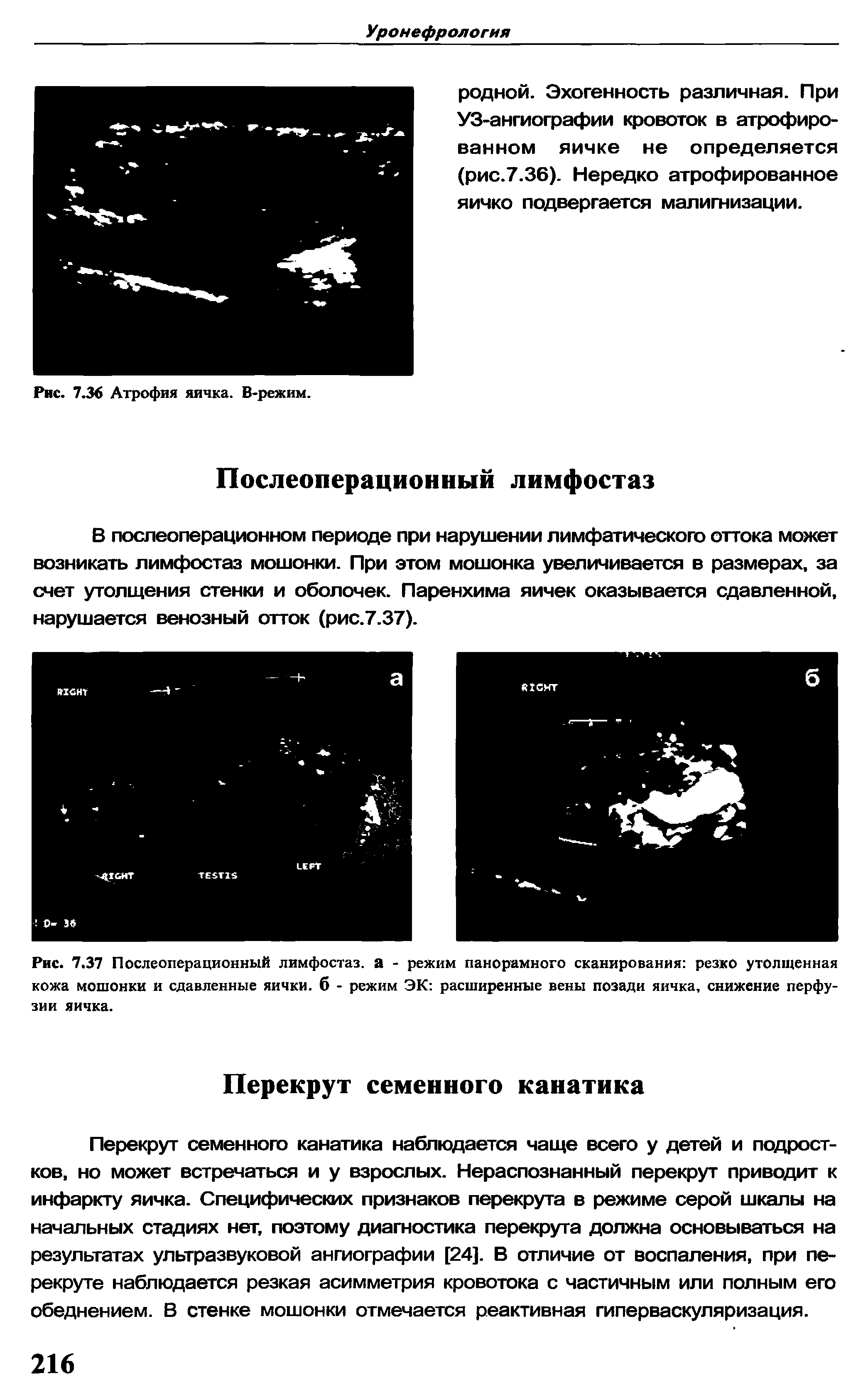 Рис. 7.37 Послеоперационный лимфостаз. а - режим панорамного сканирования резко утолщенная кожа мошонки и сдавленные яички, б - режим ЭК расширенные вены позади яичка, снижение перфузии яичка.