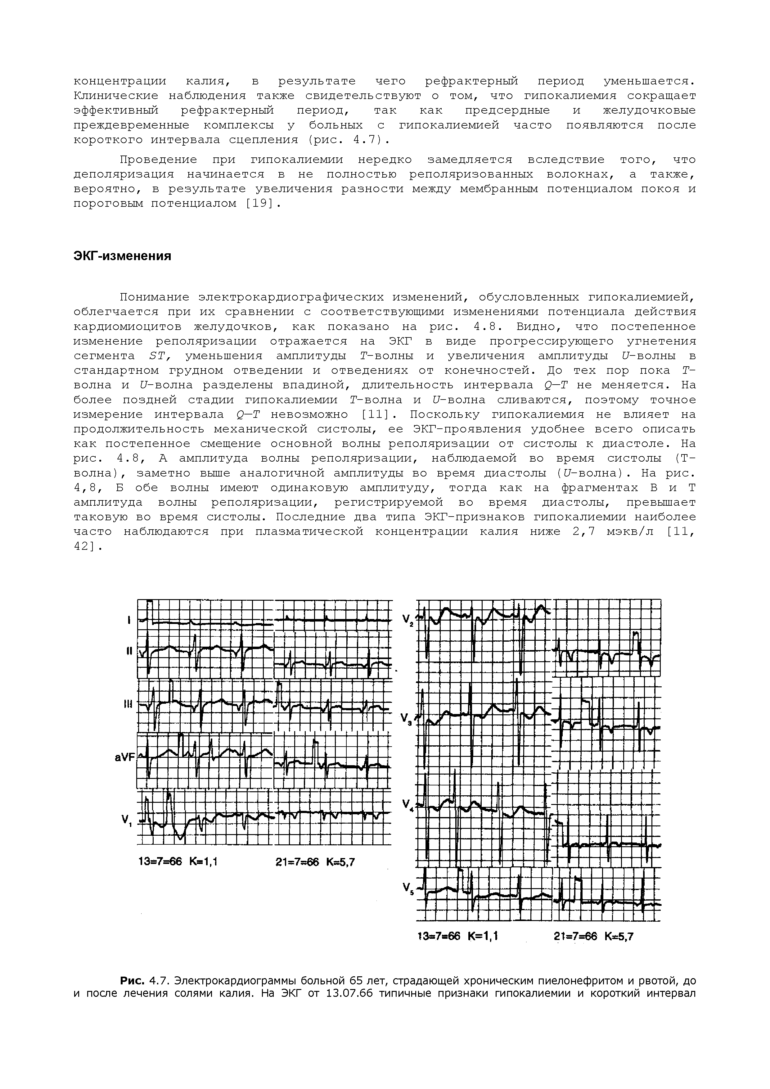 Рис. 4.7. Электрокардиограммы больной 65 лет, страдающей хроническим пиелонефритом и рвотой, до и после лечения солями калия. На ЭКГ от 13.07.66 типичные признаки гипокалиемии и короткий интервал...