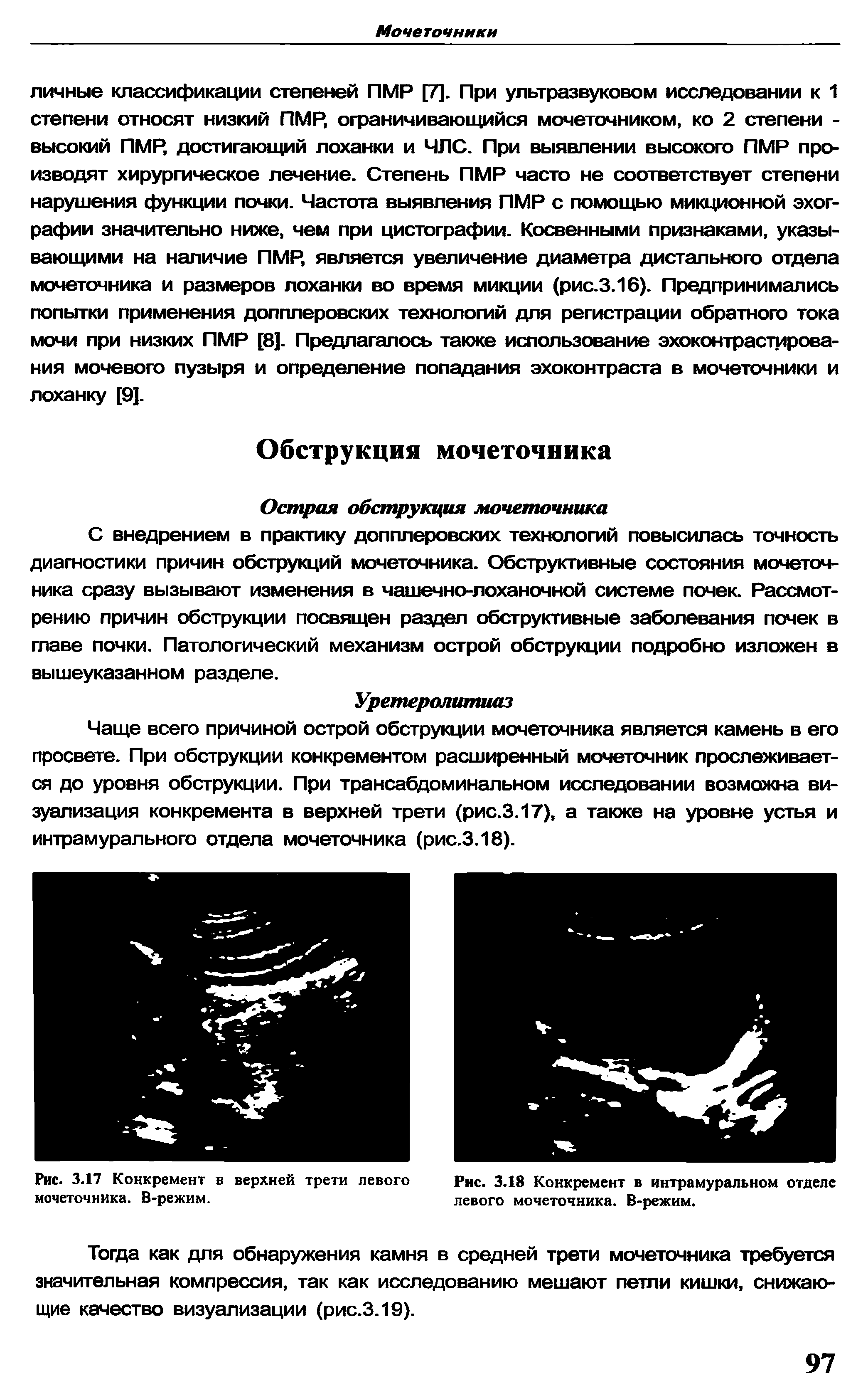 Рис. 3.18 Конкремент в интрамуральном отделе левого мочеточника. В-режим.